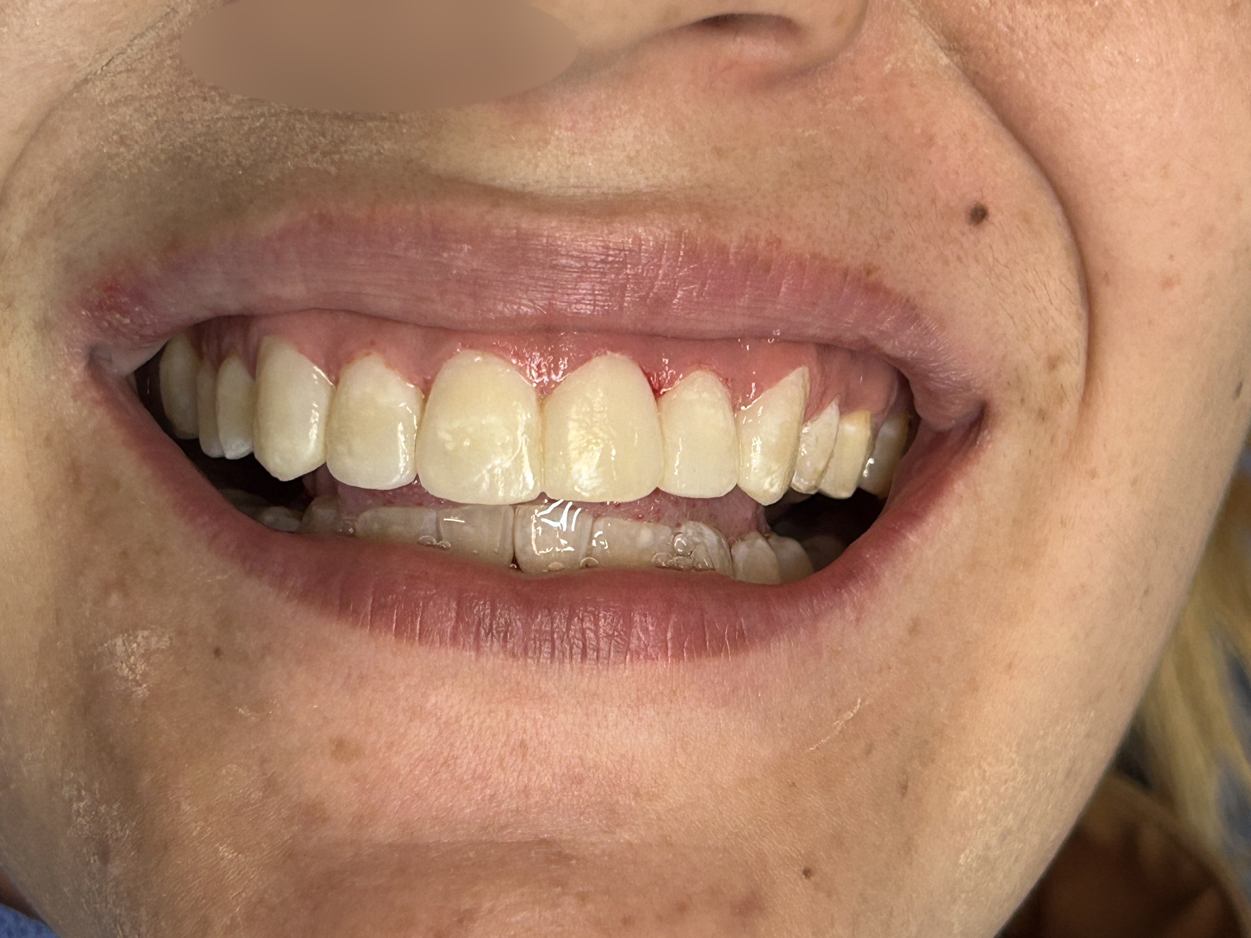 Herpes labial: caso