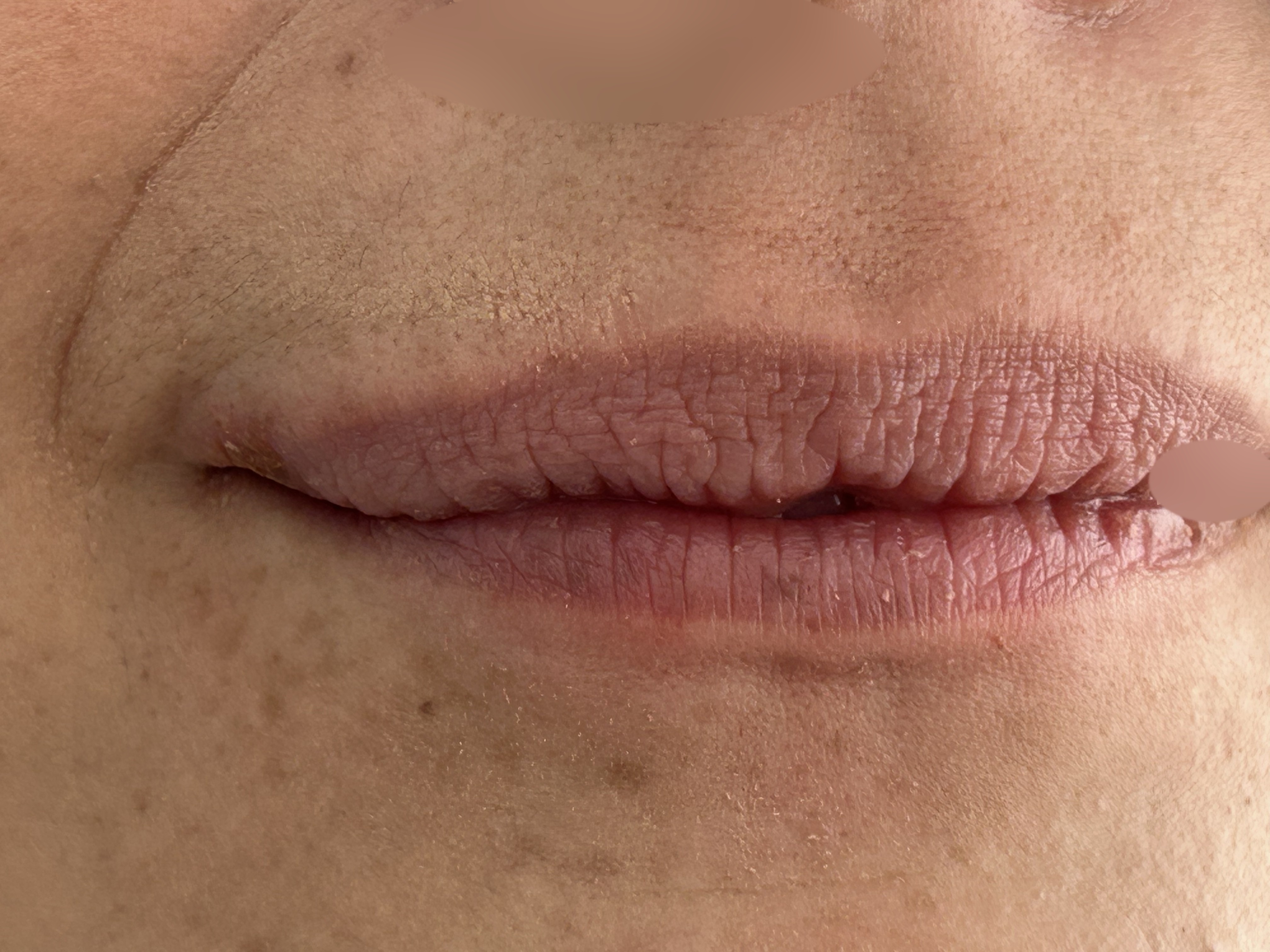 Herpes labial: caso
