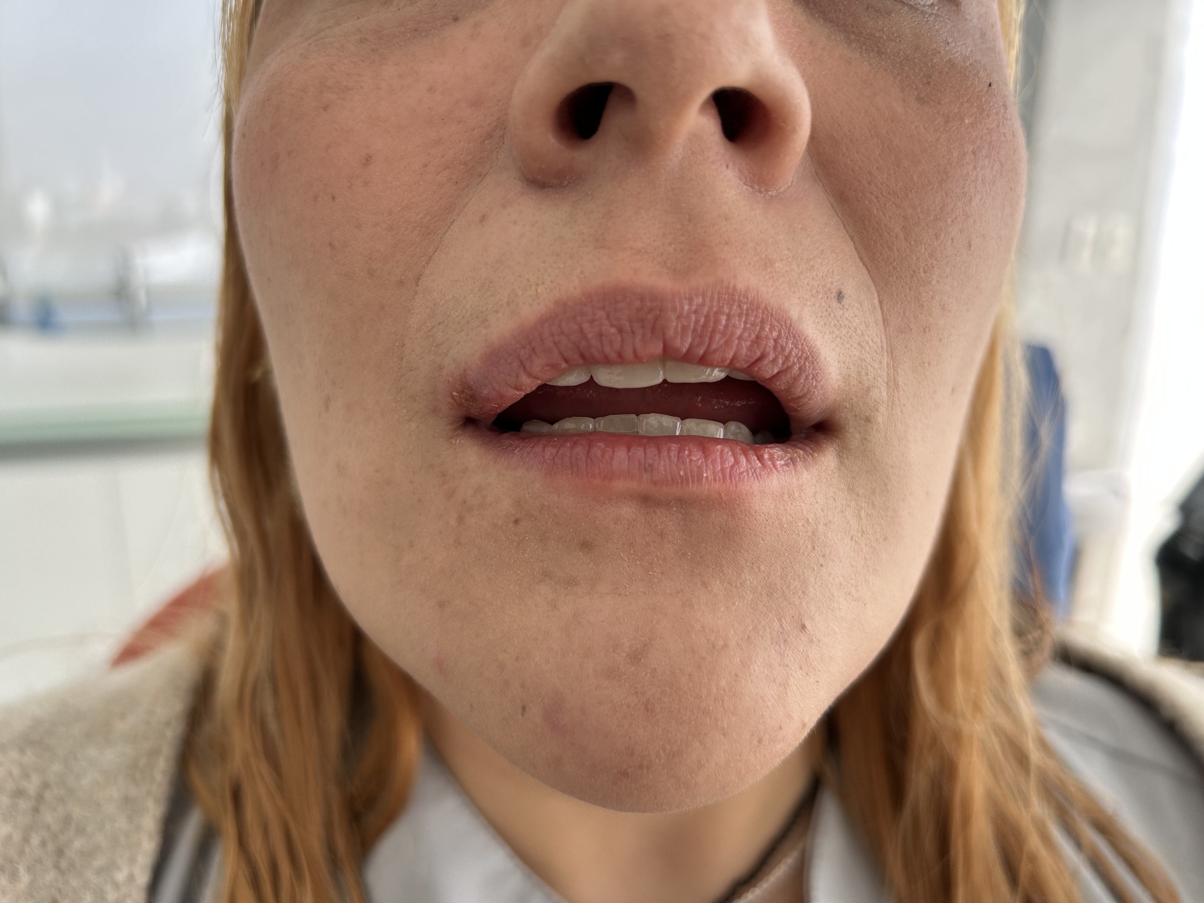 Herpes labial: caso