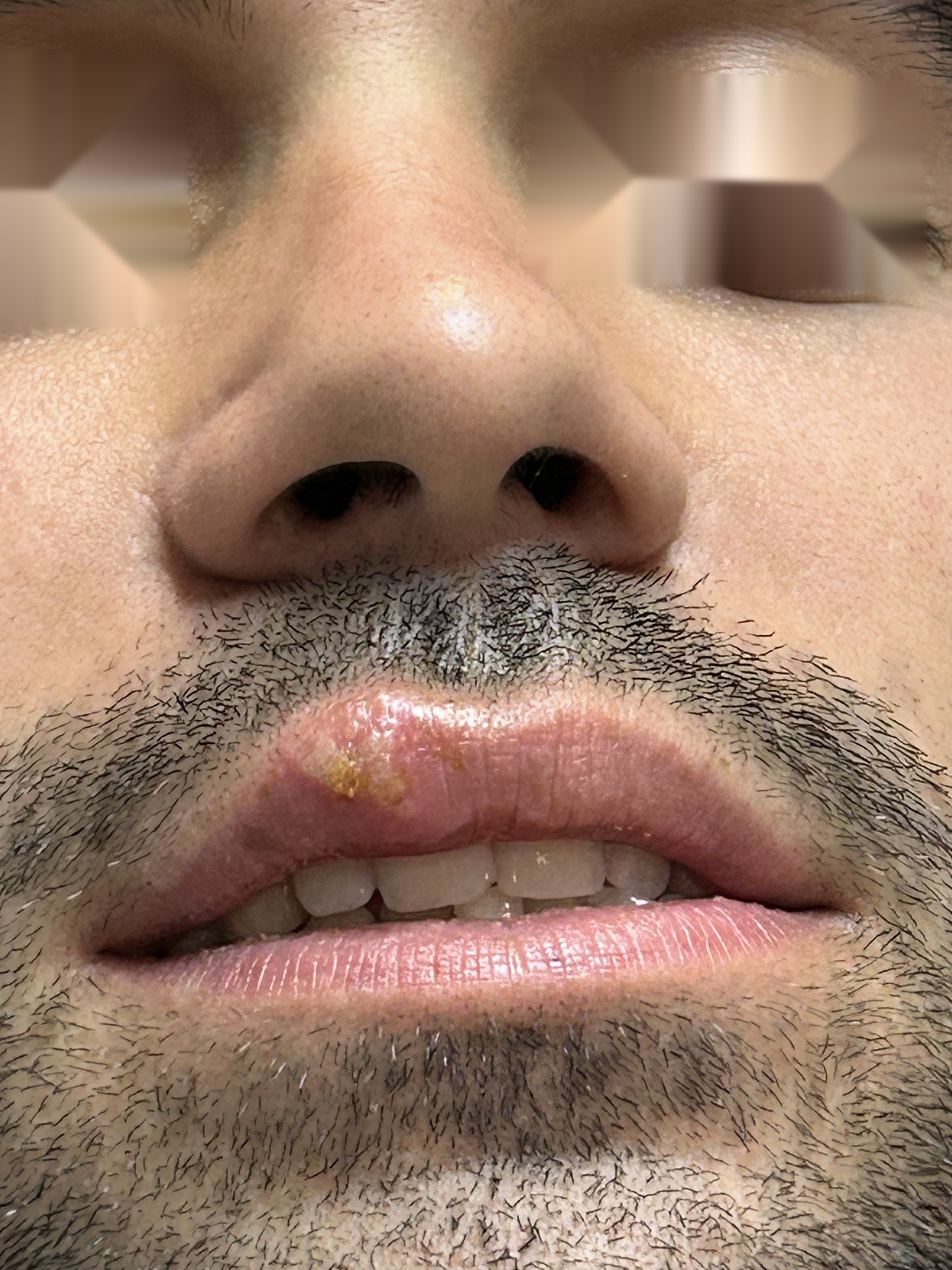 Herpes labial: caso