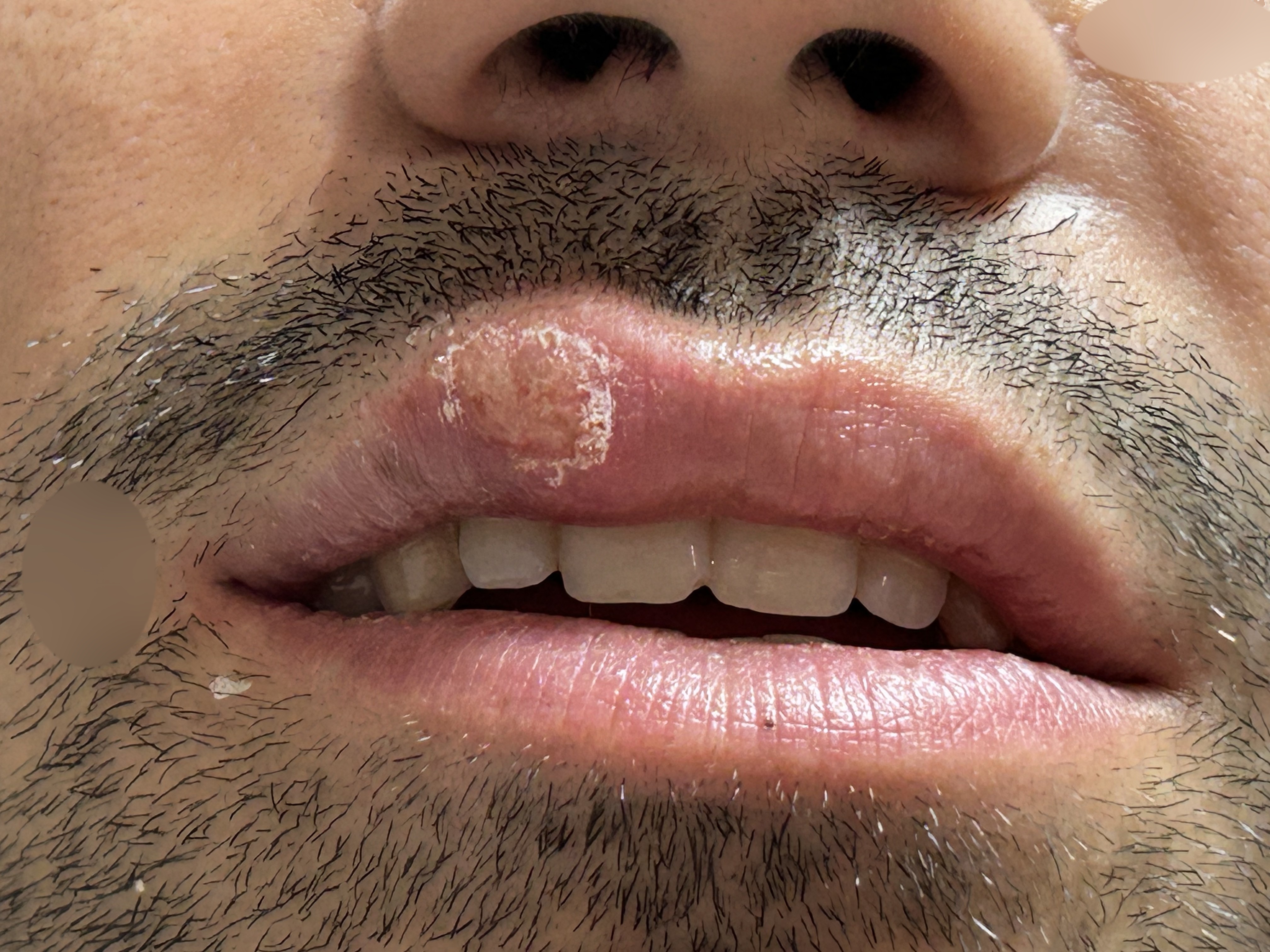 Herpes labial: caso