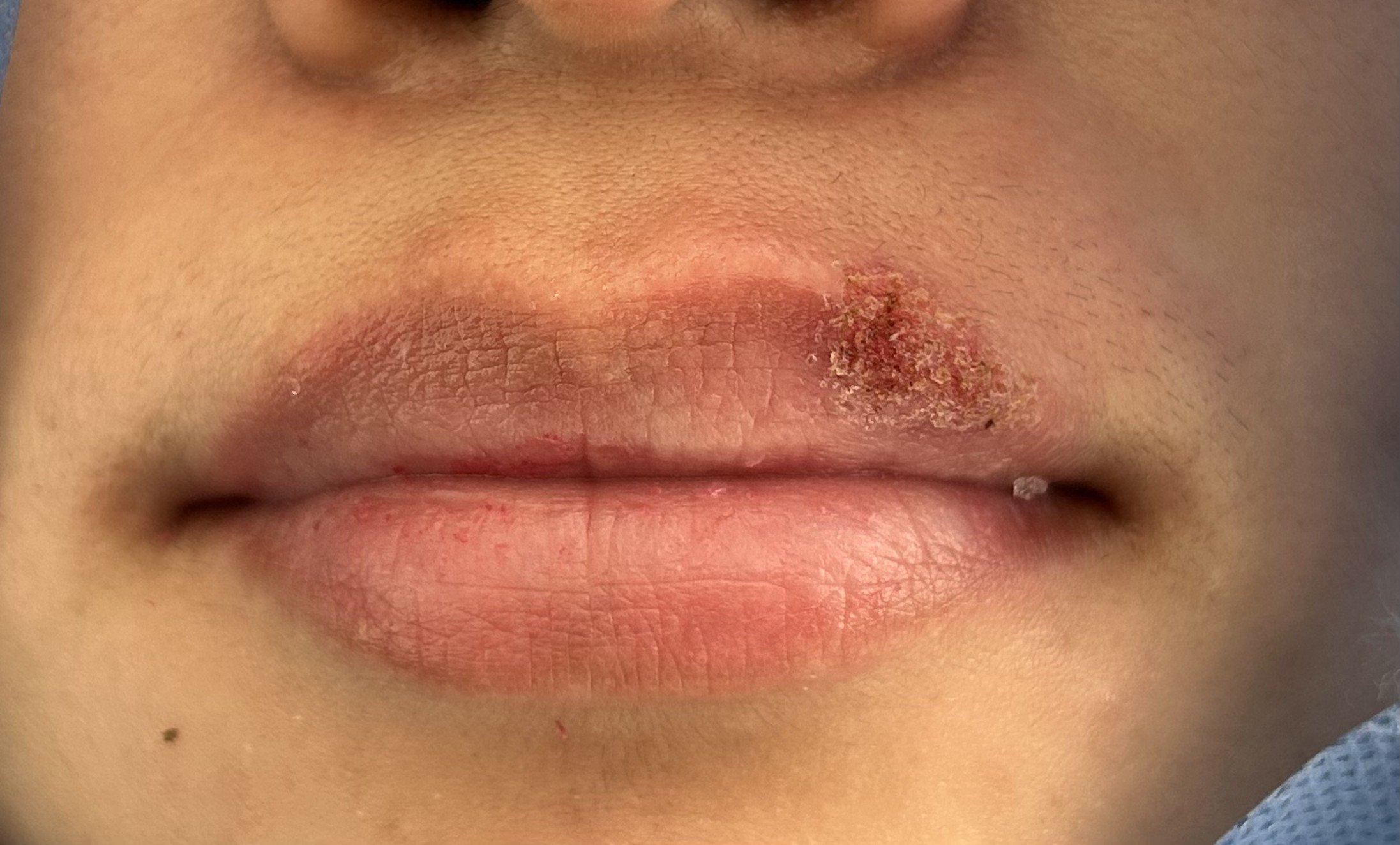 Herpes labial: caso