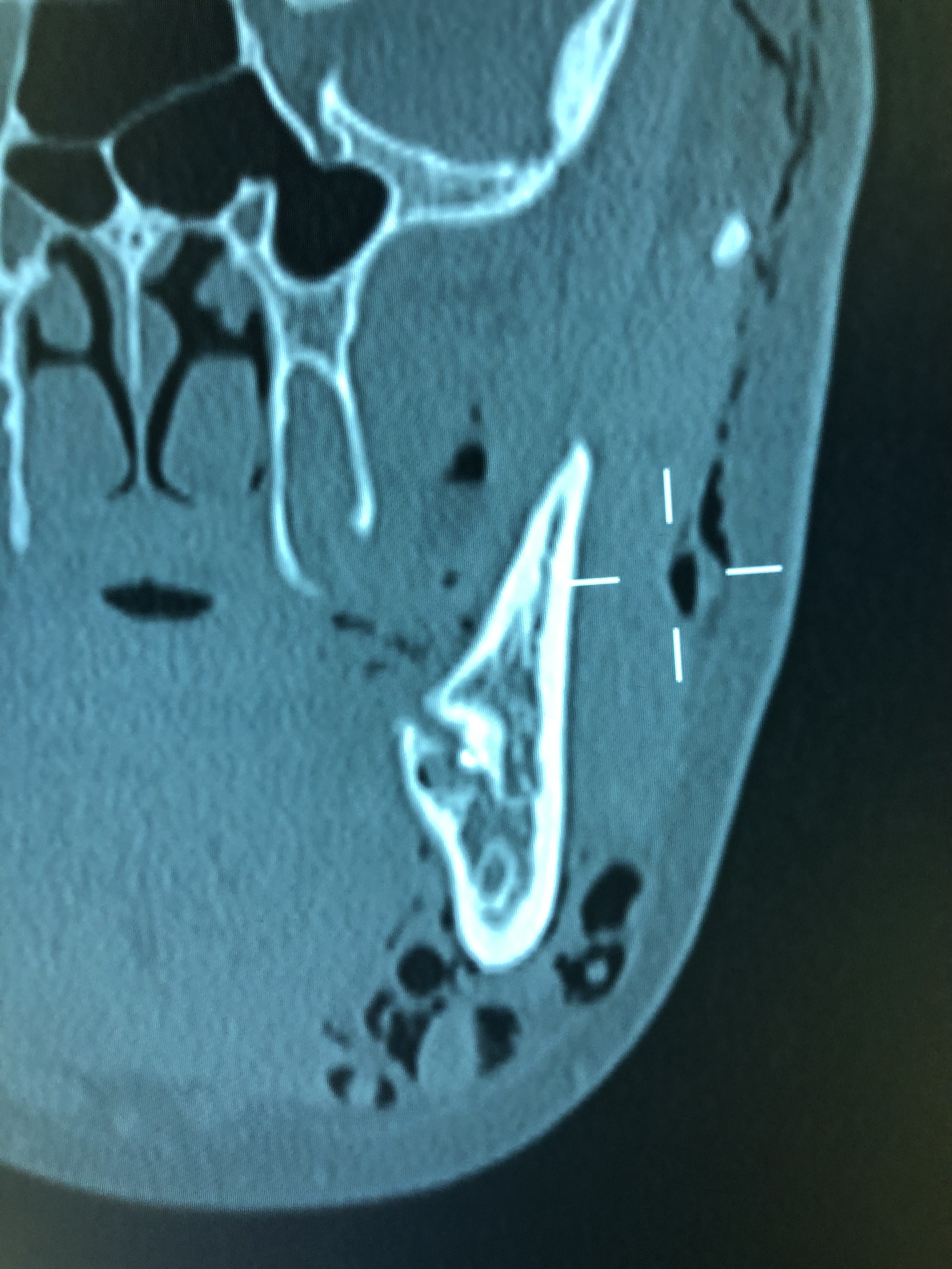 Absceso mandibular / fractura por intento de extracción