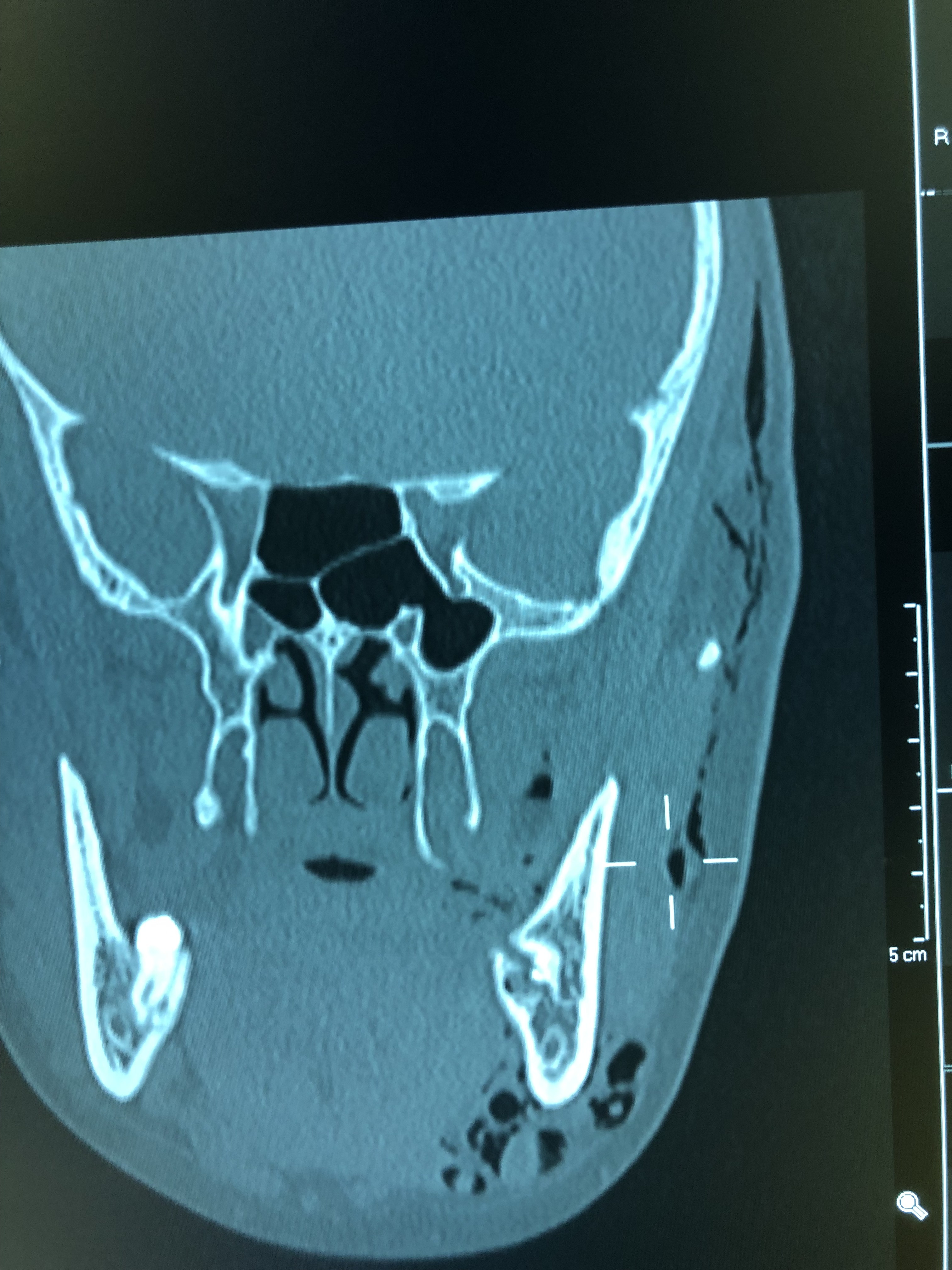 Absceso mandibular / fractura por intento de extracción