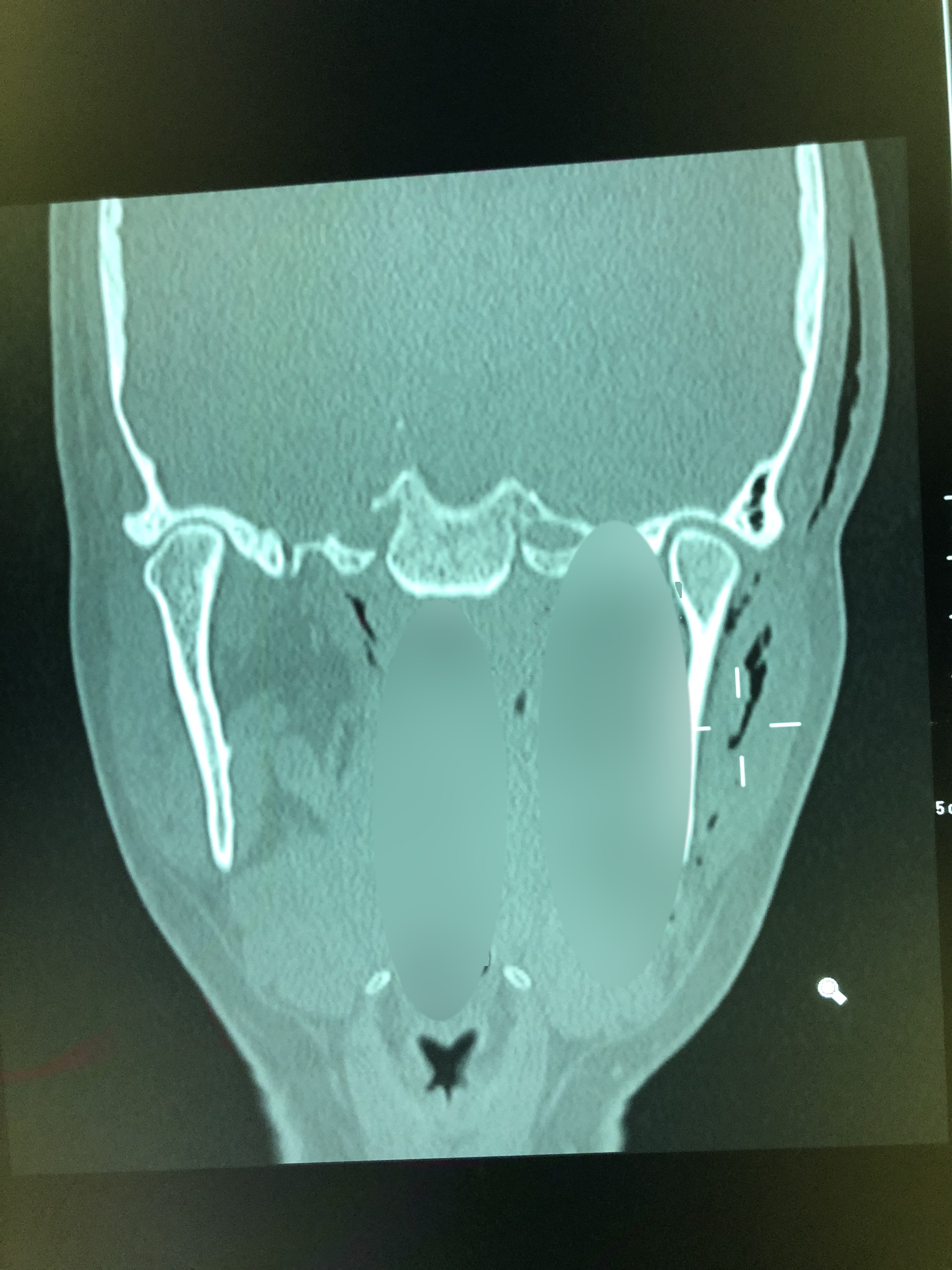 Absceso mandibular / fractura por intento de extracción