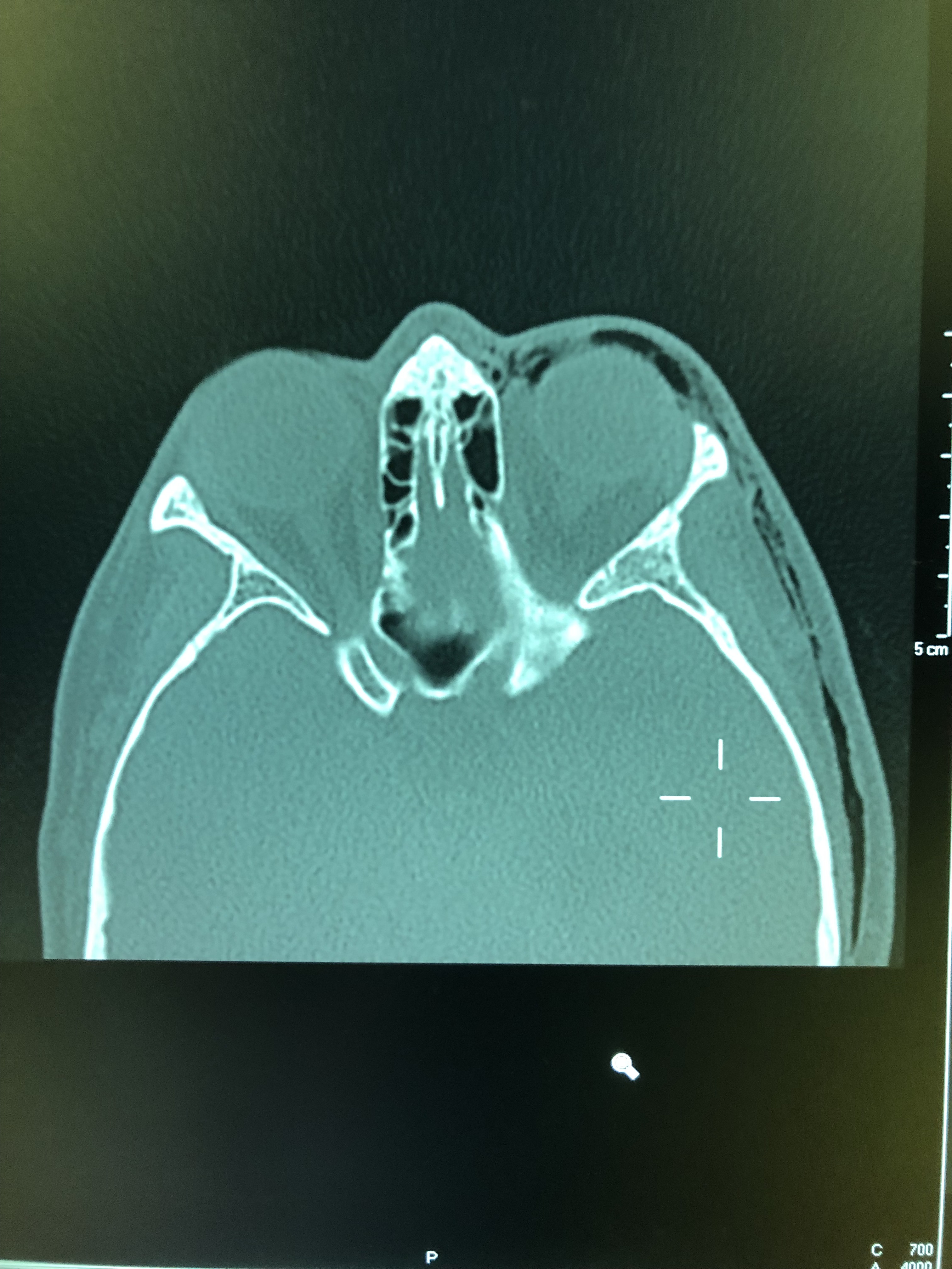 Absceso mandibular / fractura por intento de extracción