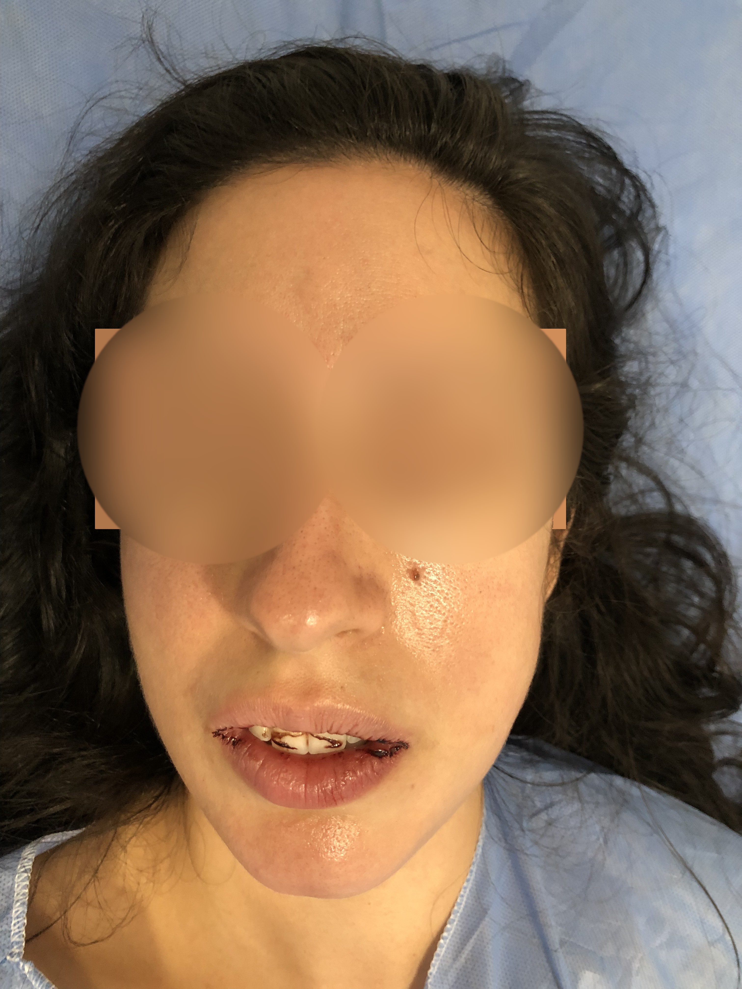Absceso mandibular / fractura por intento de extracción