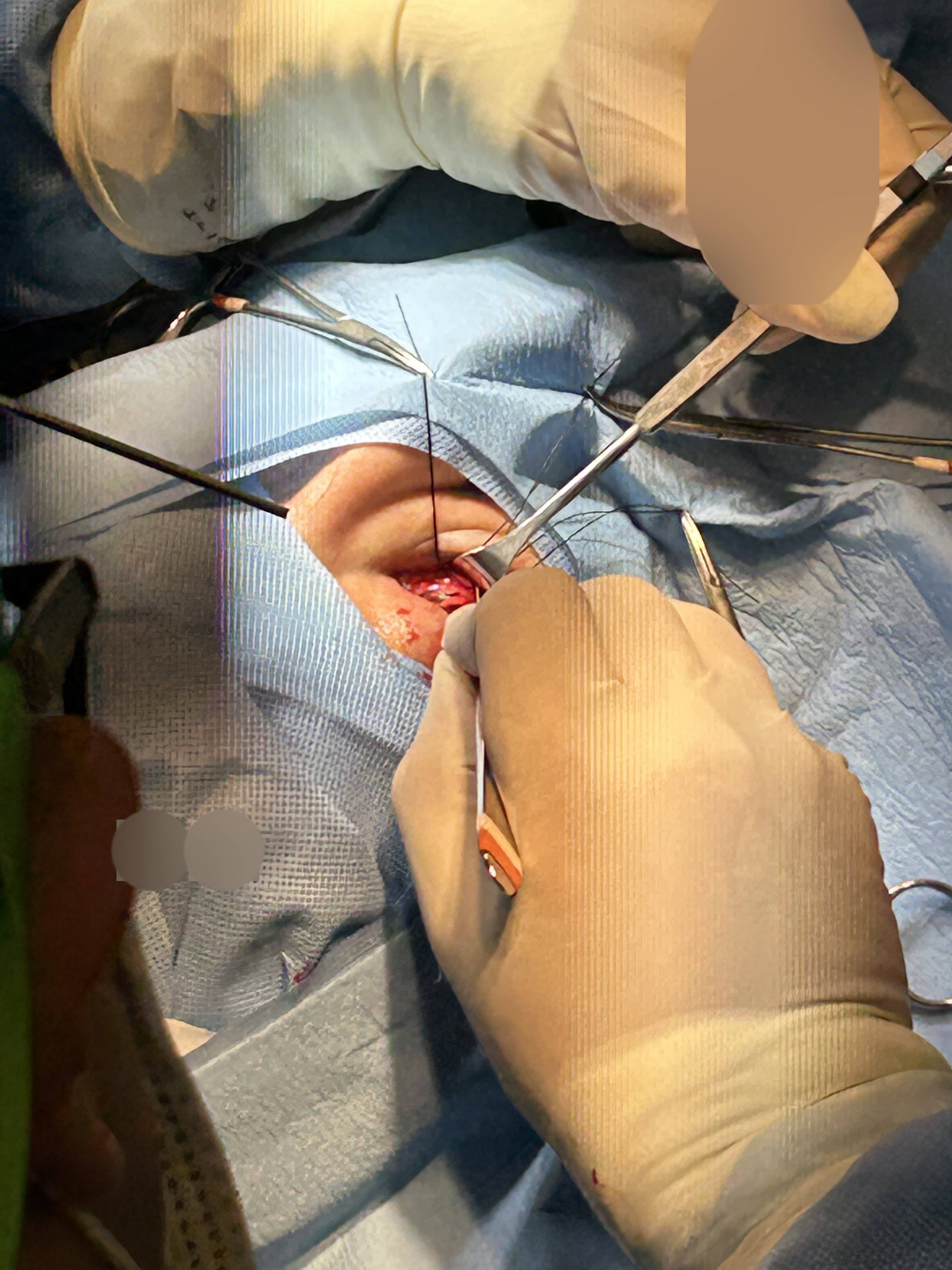 Fractura de órbita (manejo inadecuado)