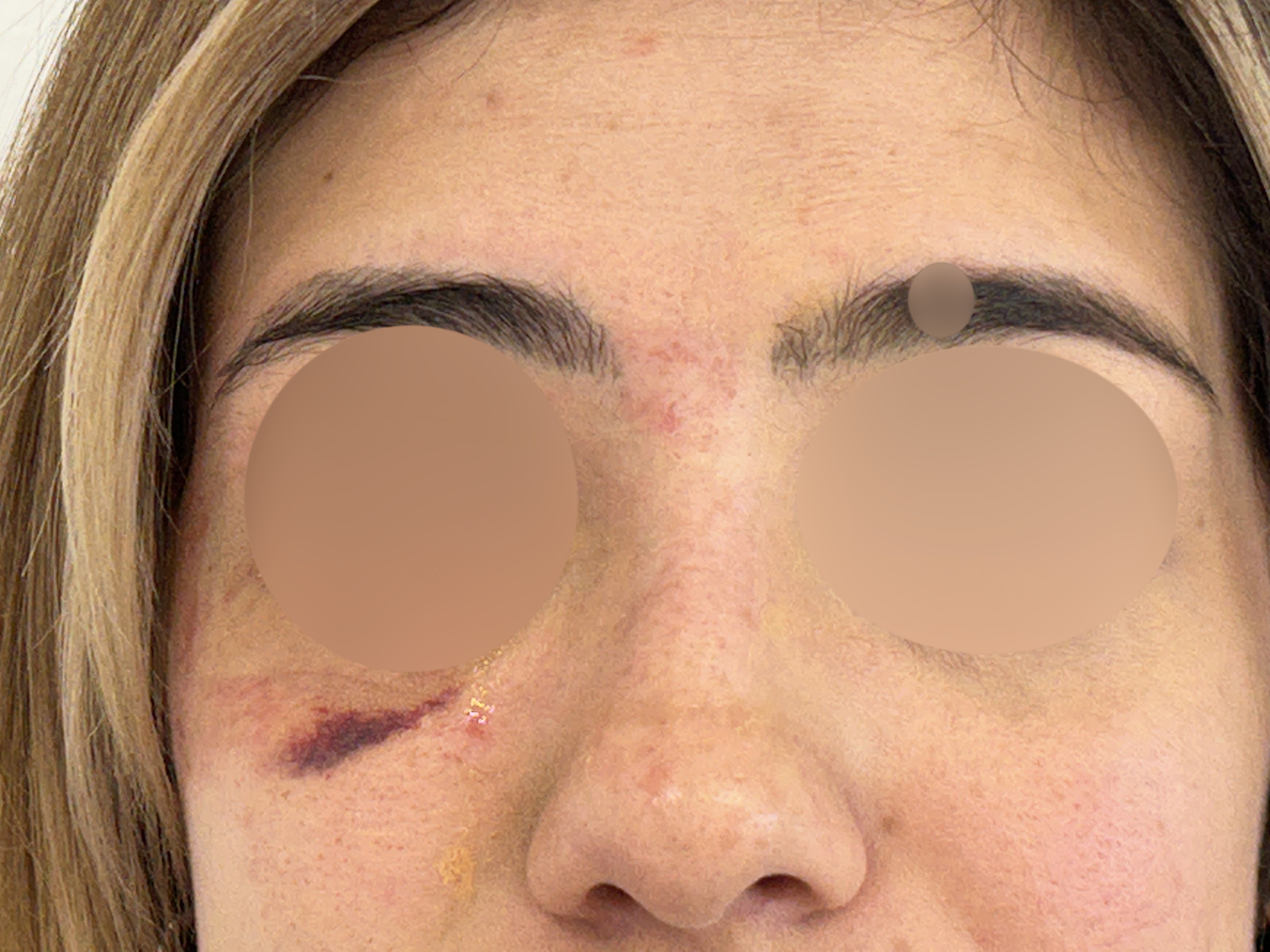 Fractura de órbita (manejo inadecuado)