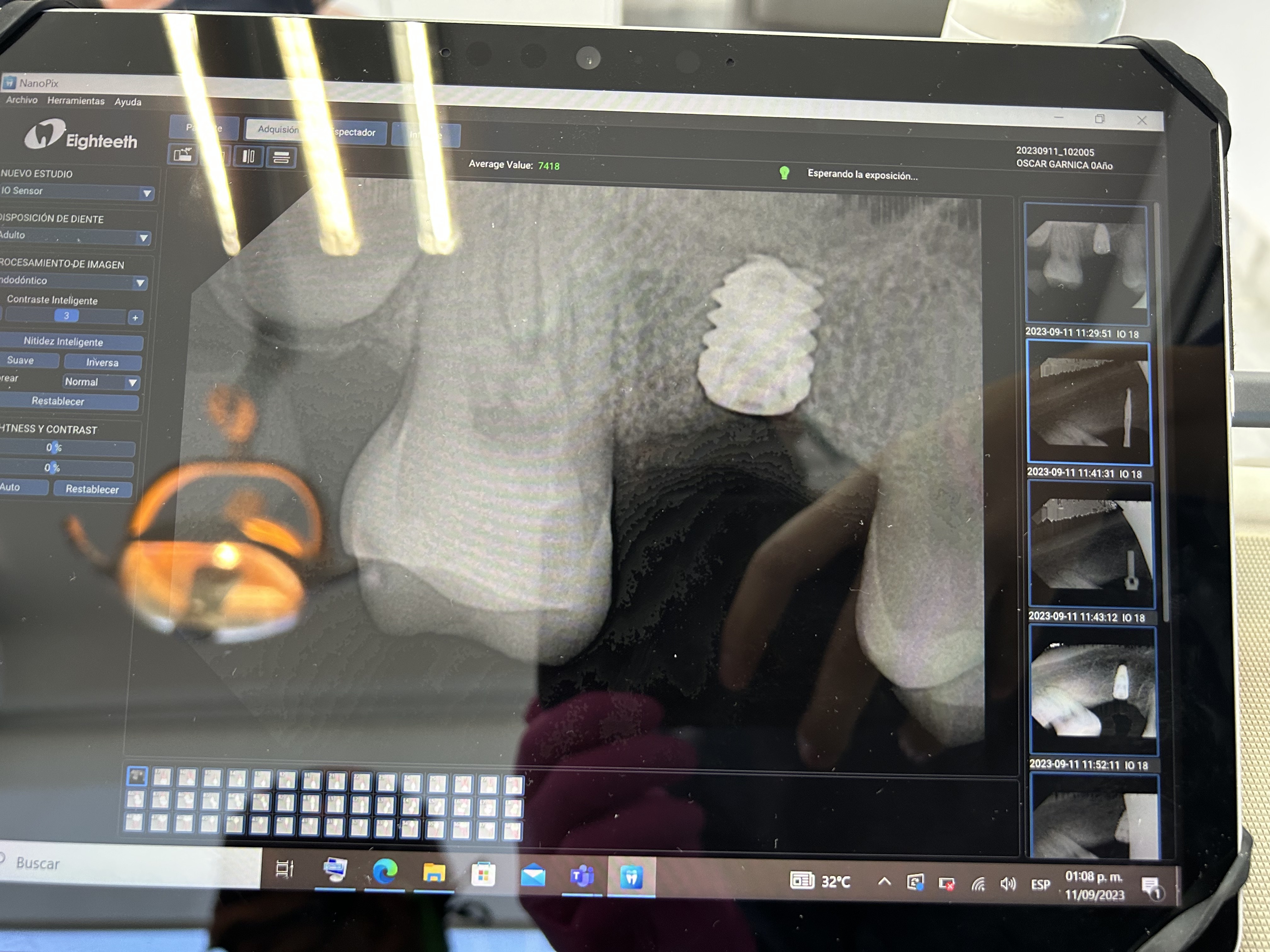 Implant at the maxillary sinus border