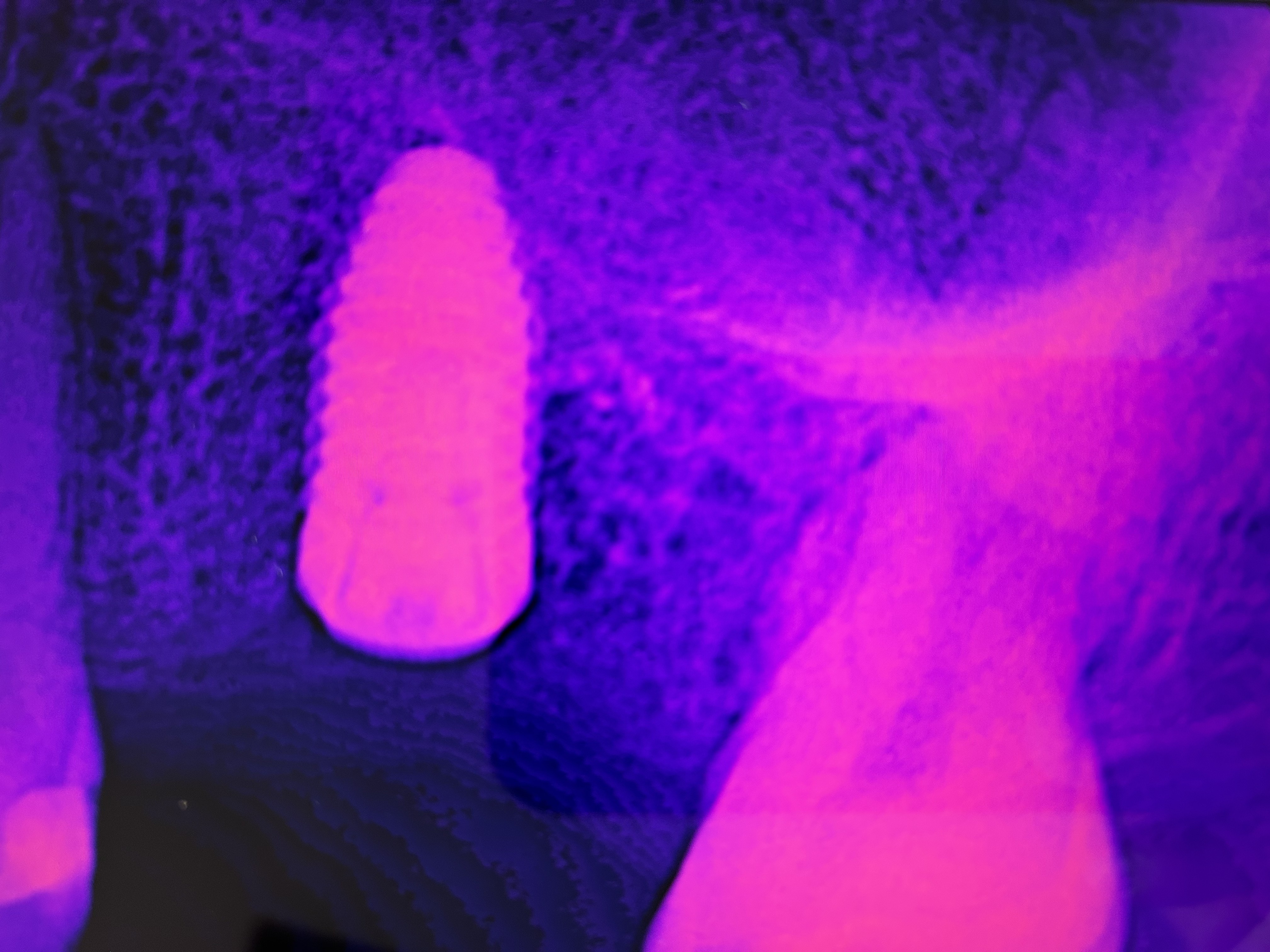 Implant at the maxillary sinus border