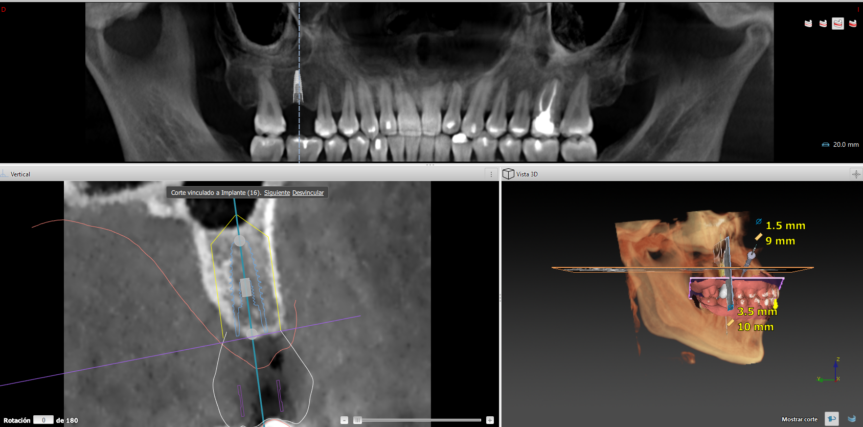 Digital planning: surgical guide