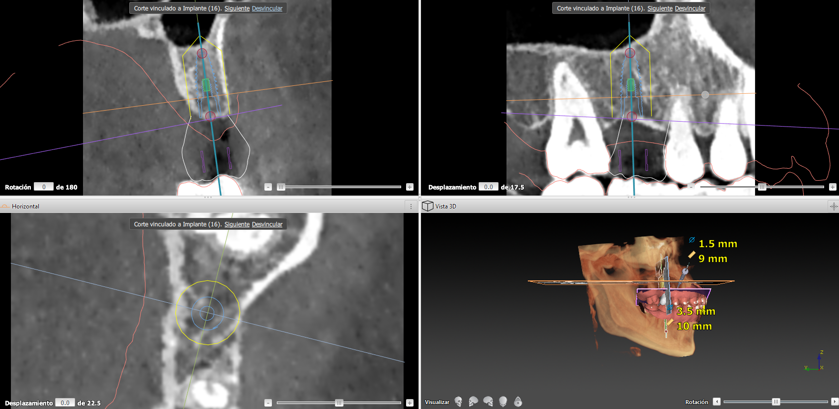 Digital planning: surgical guide