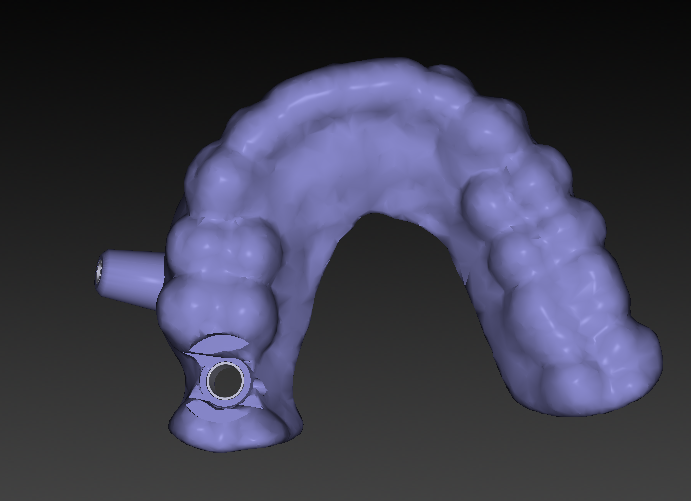 Digital planning: surgical guide