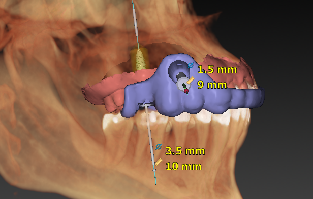 Digital planning: surgical guide