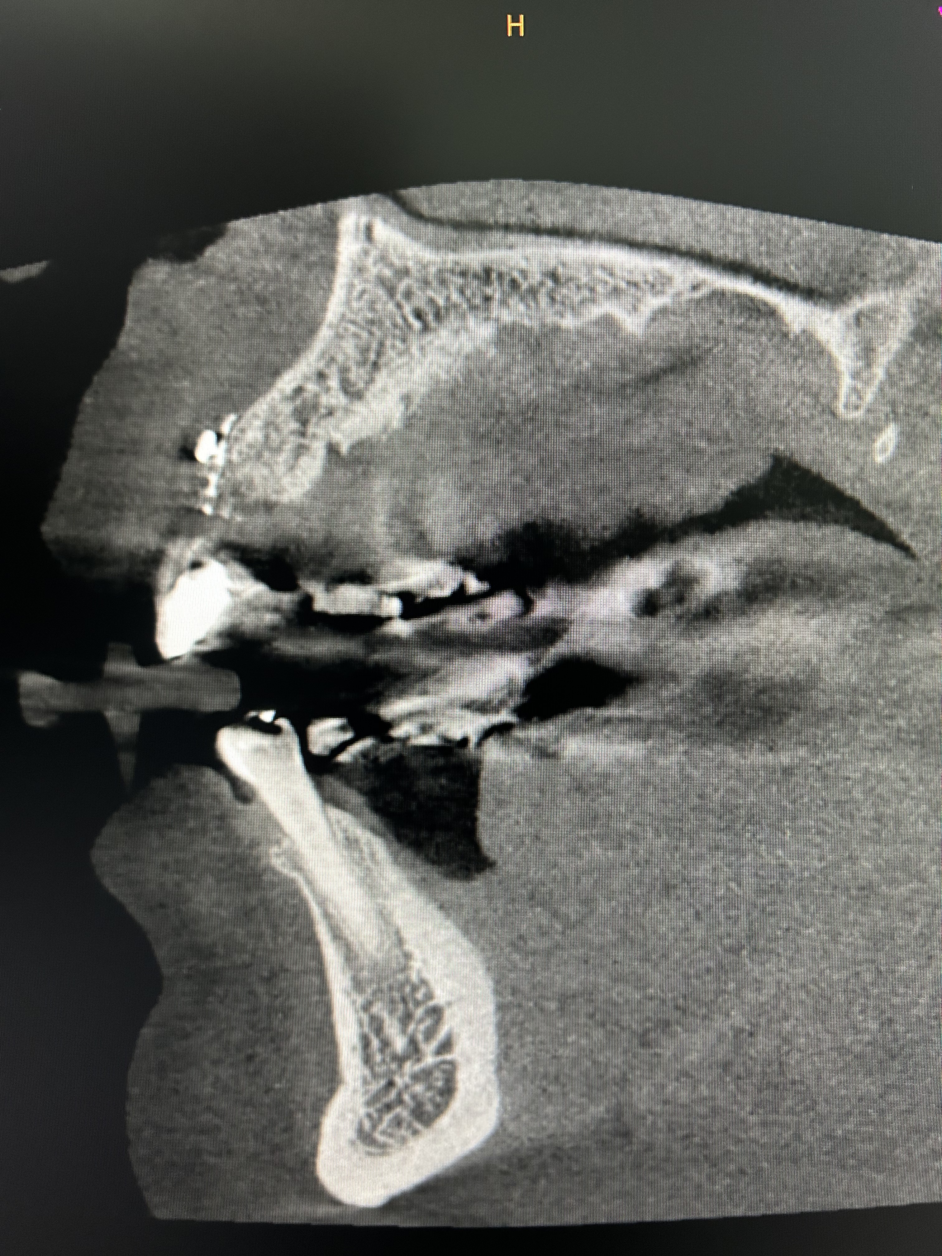 Case: 1 implant with reconstruction