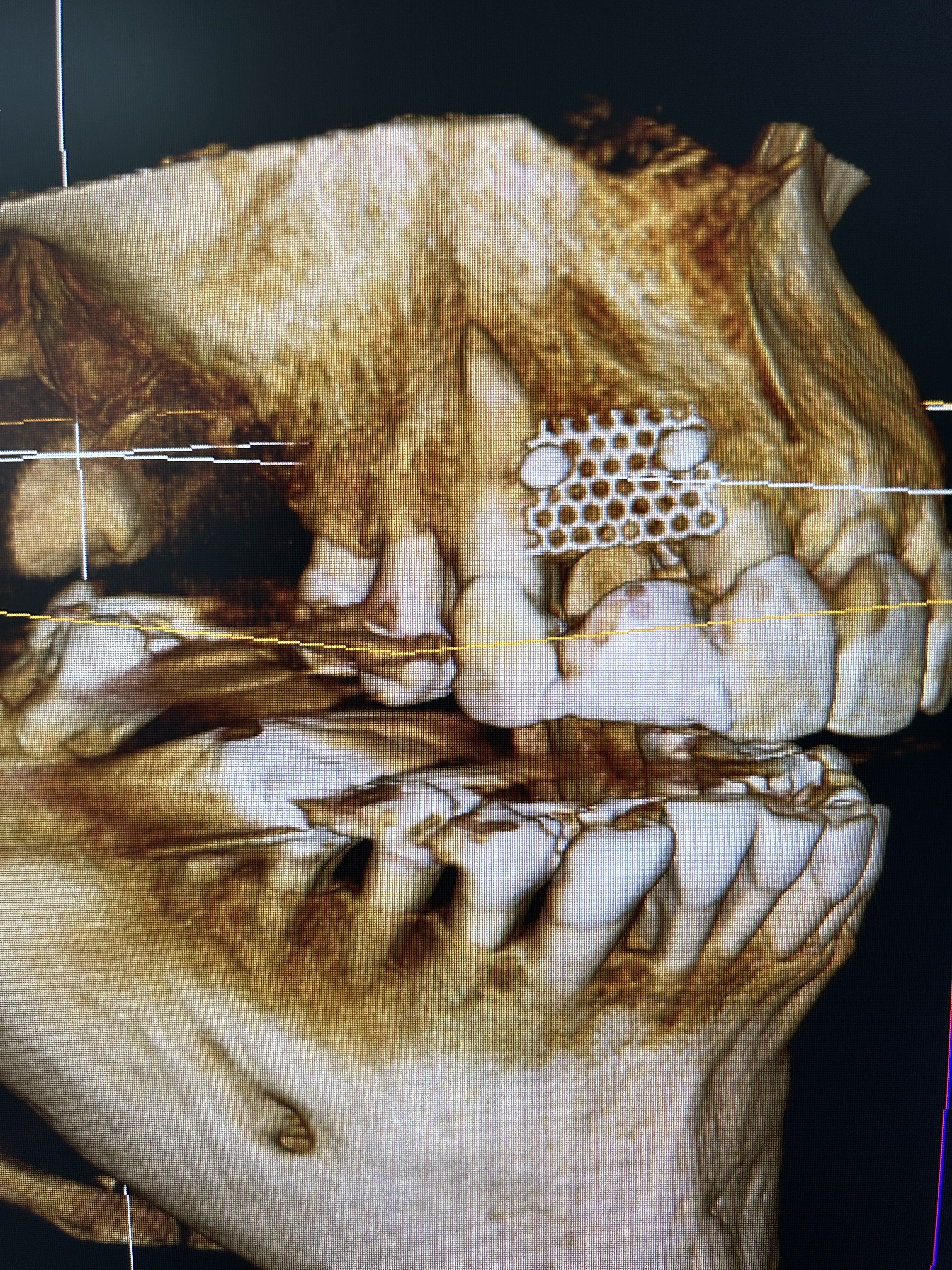 Case: 1 implant with reconstruction
