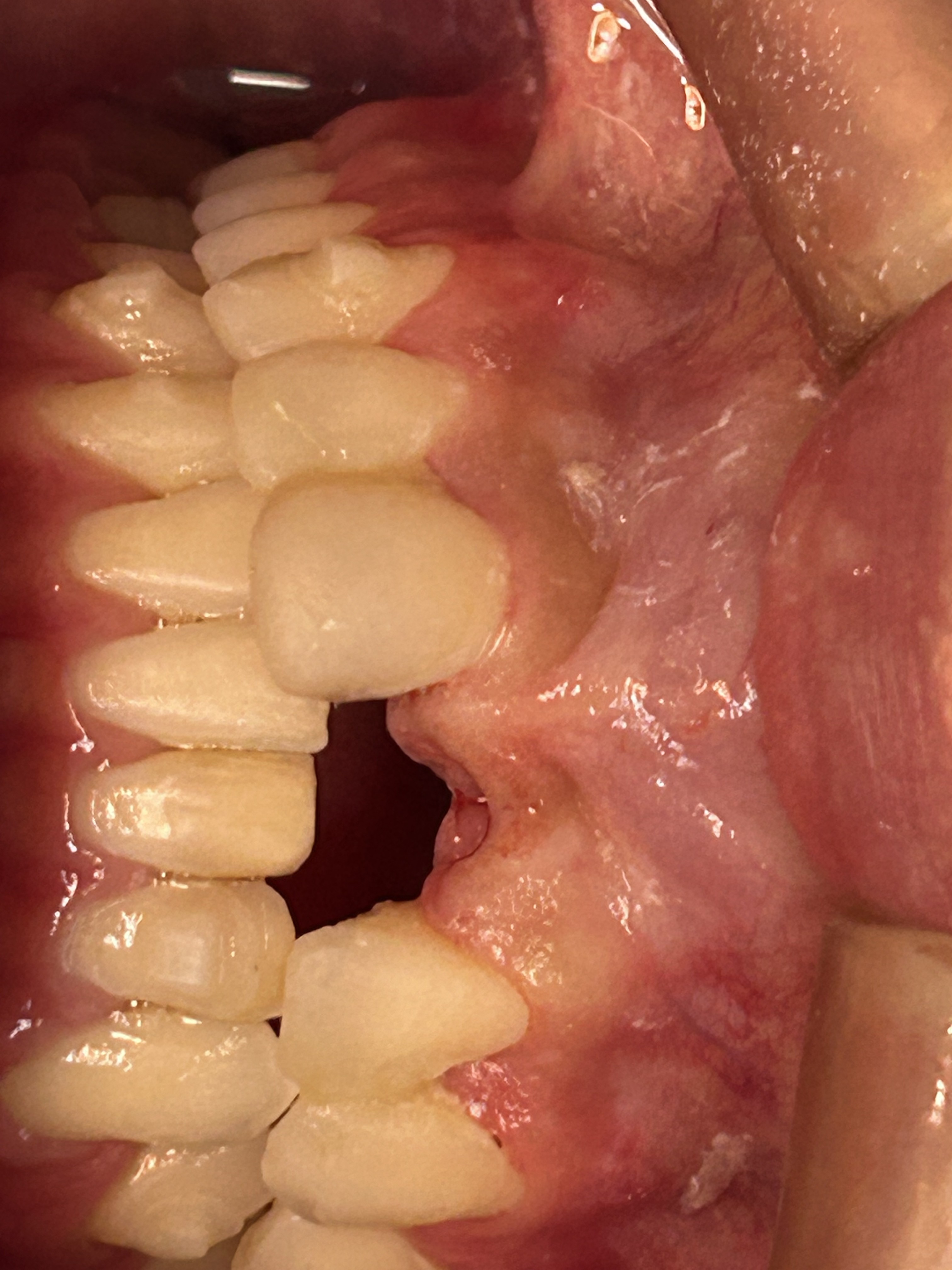 Case: 2 implants with reconstruction