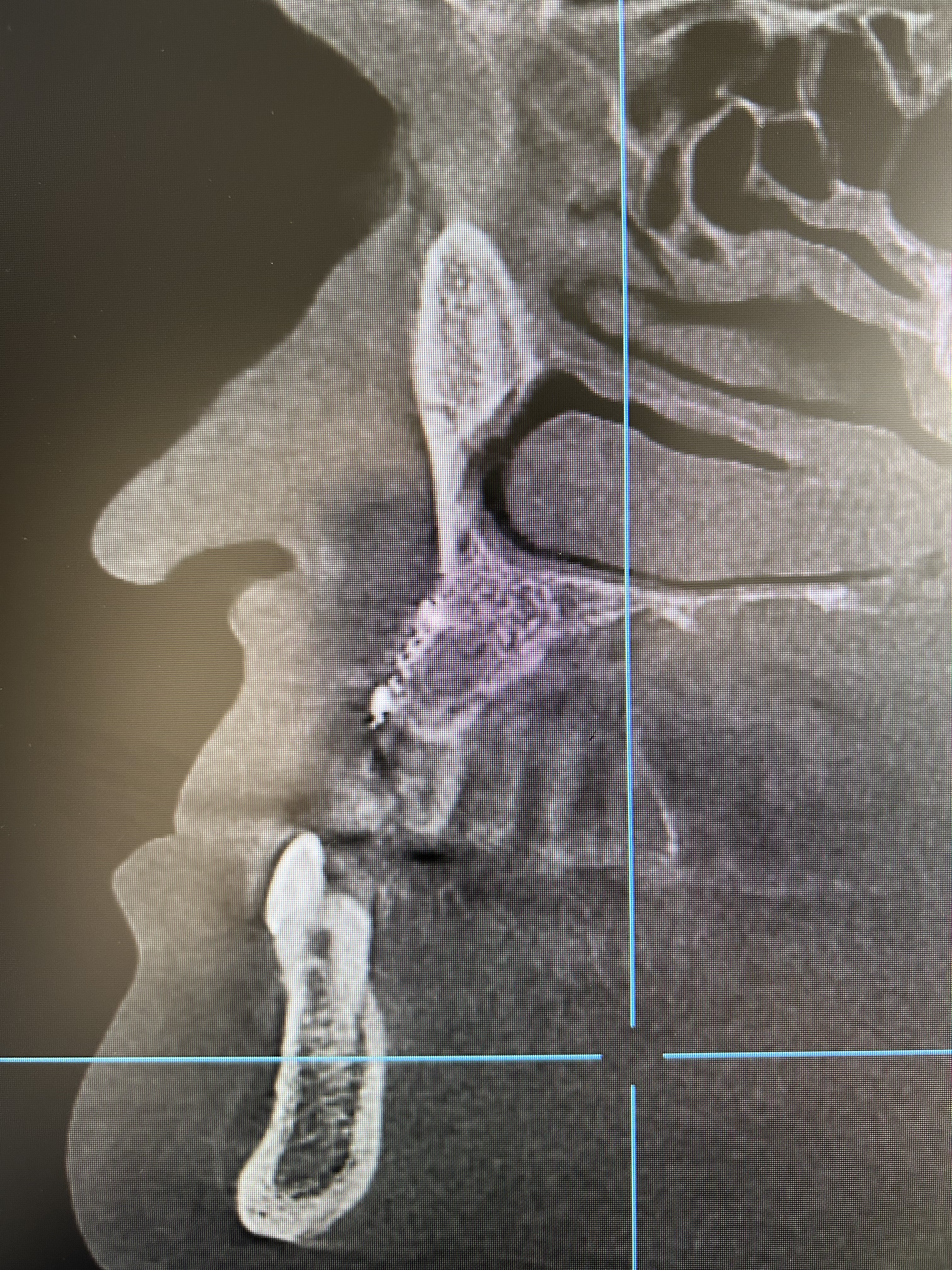 Case: 2 implants with reconstruction