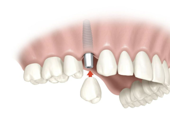 Dental implant diagram