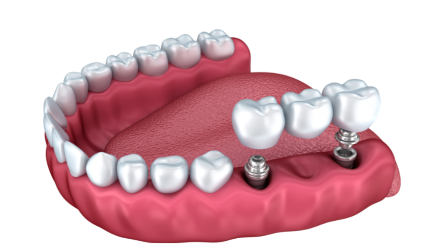 Dental implant diagram