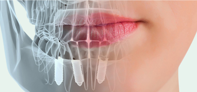 Dental implant diagram
