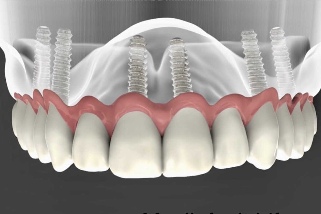 Dental implants (promo)