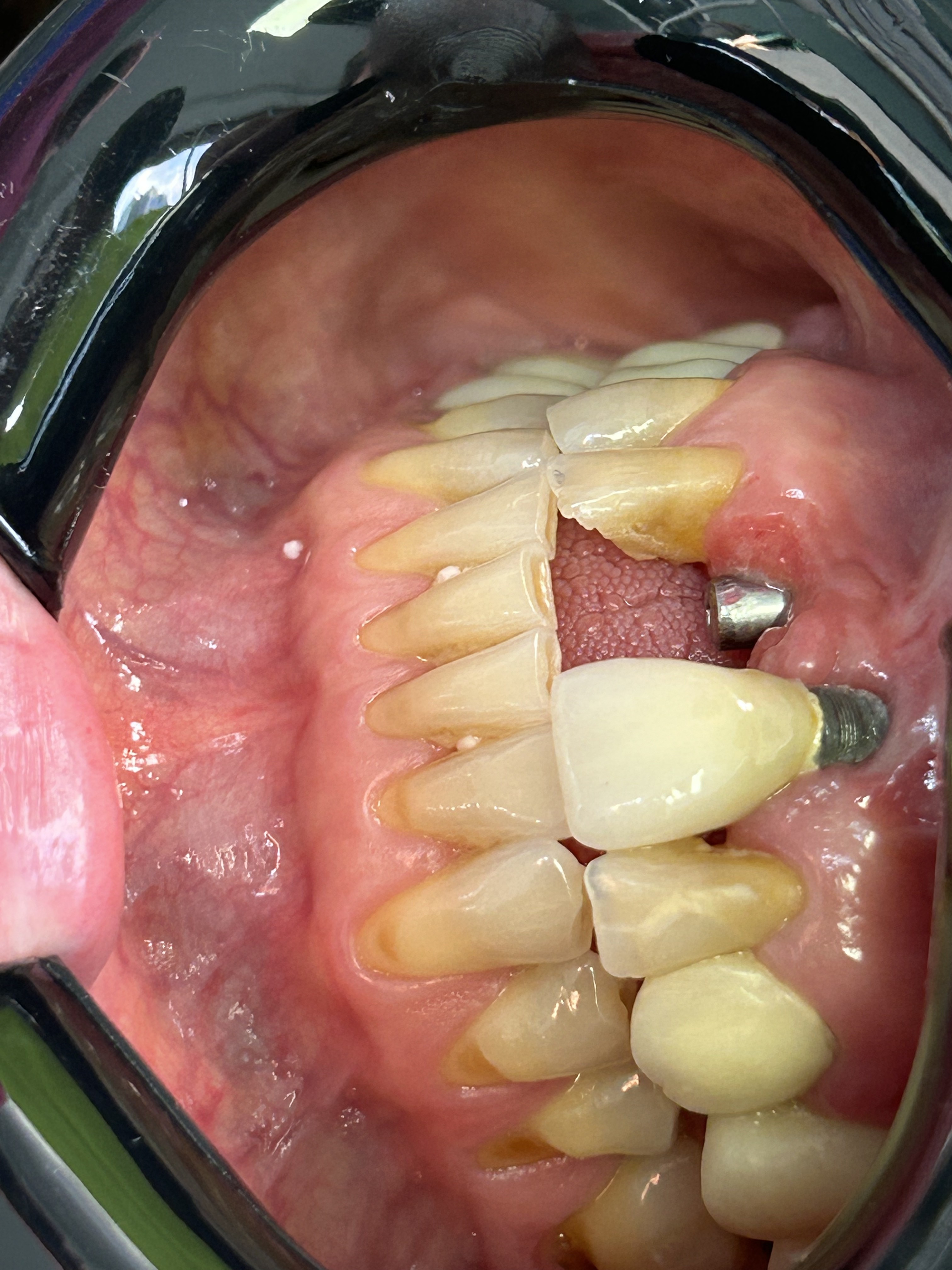 Peri-implantitis
