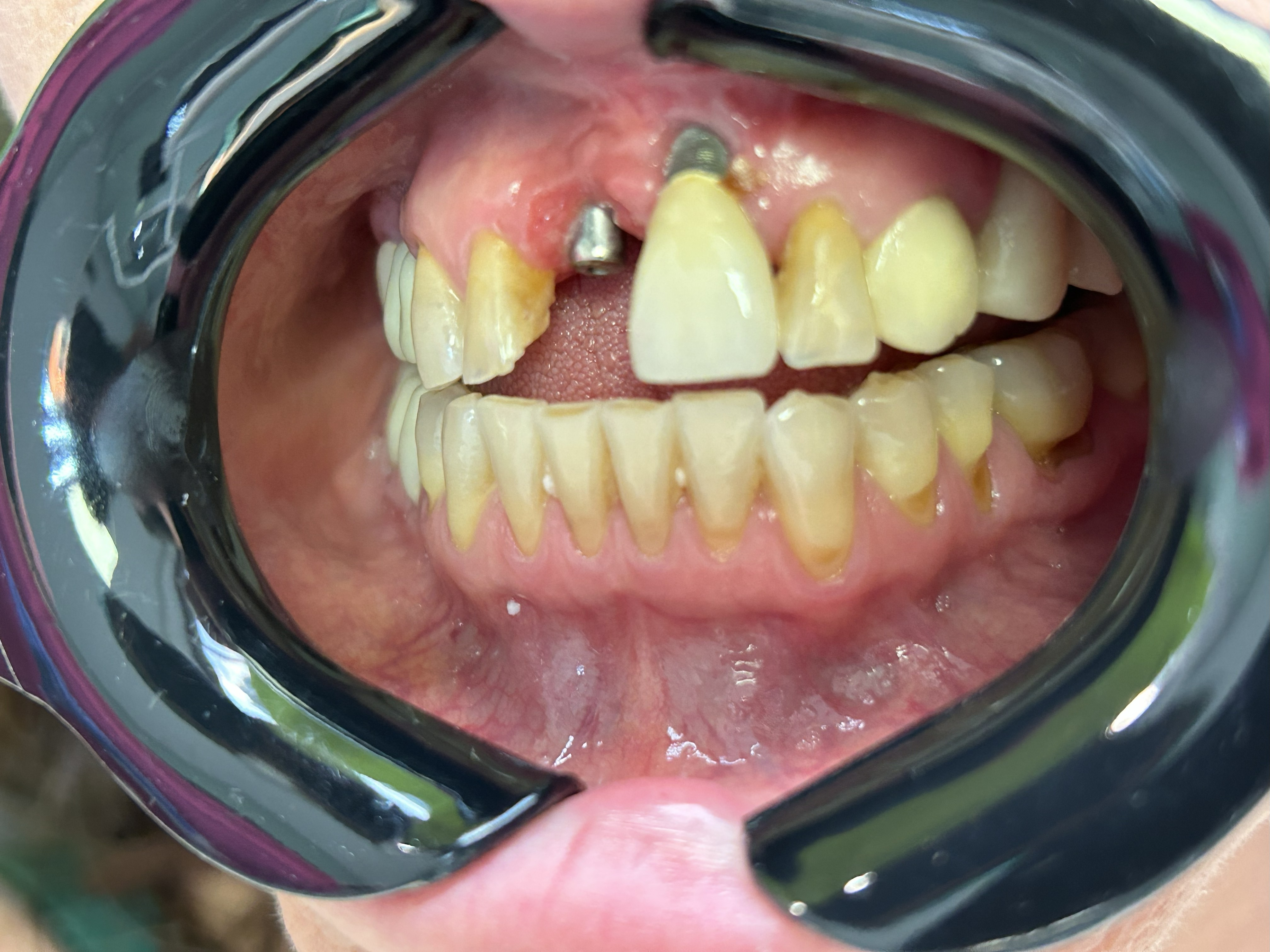 Peri-implantitis