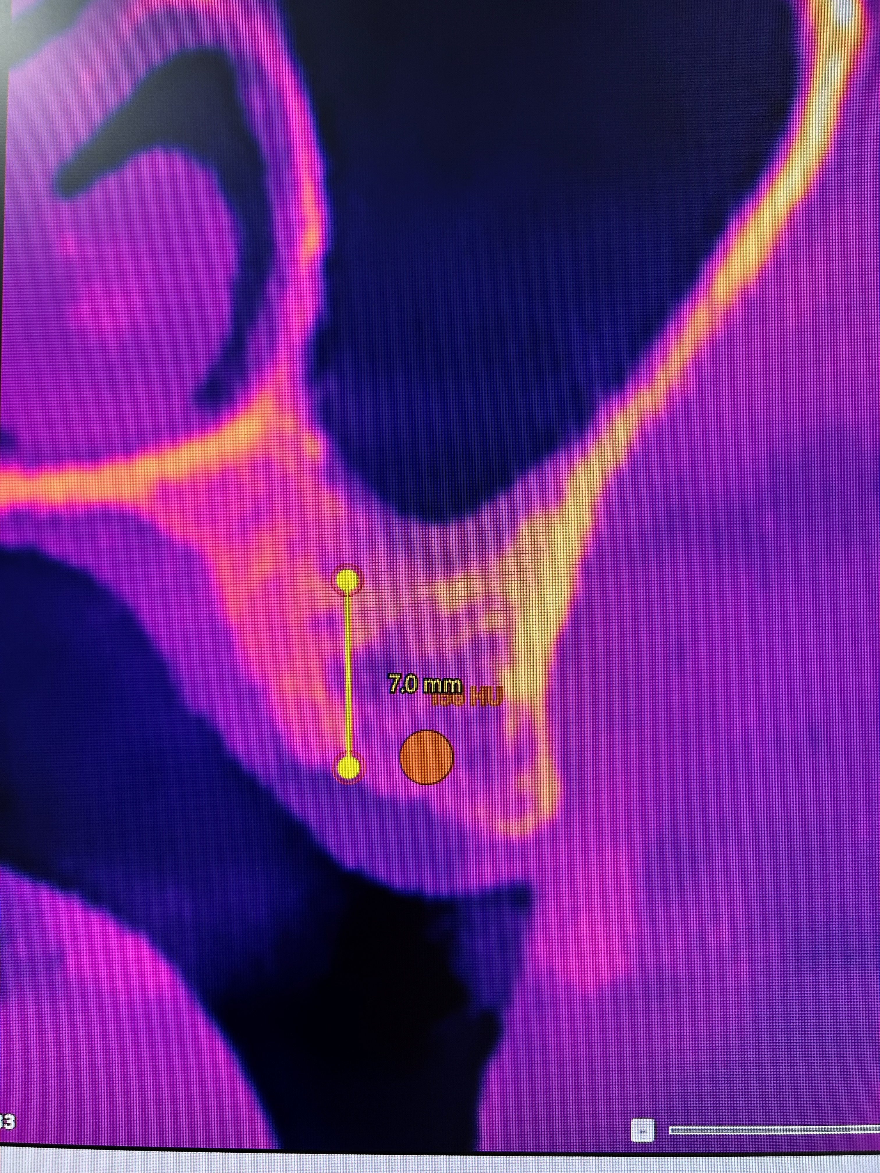 Extra-short implant with transantral elevation
