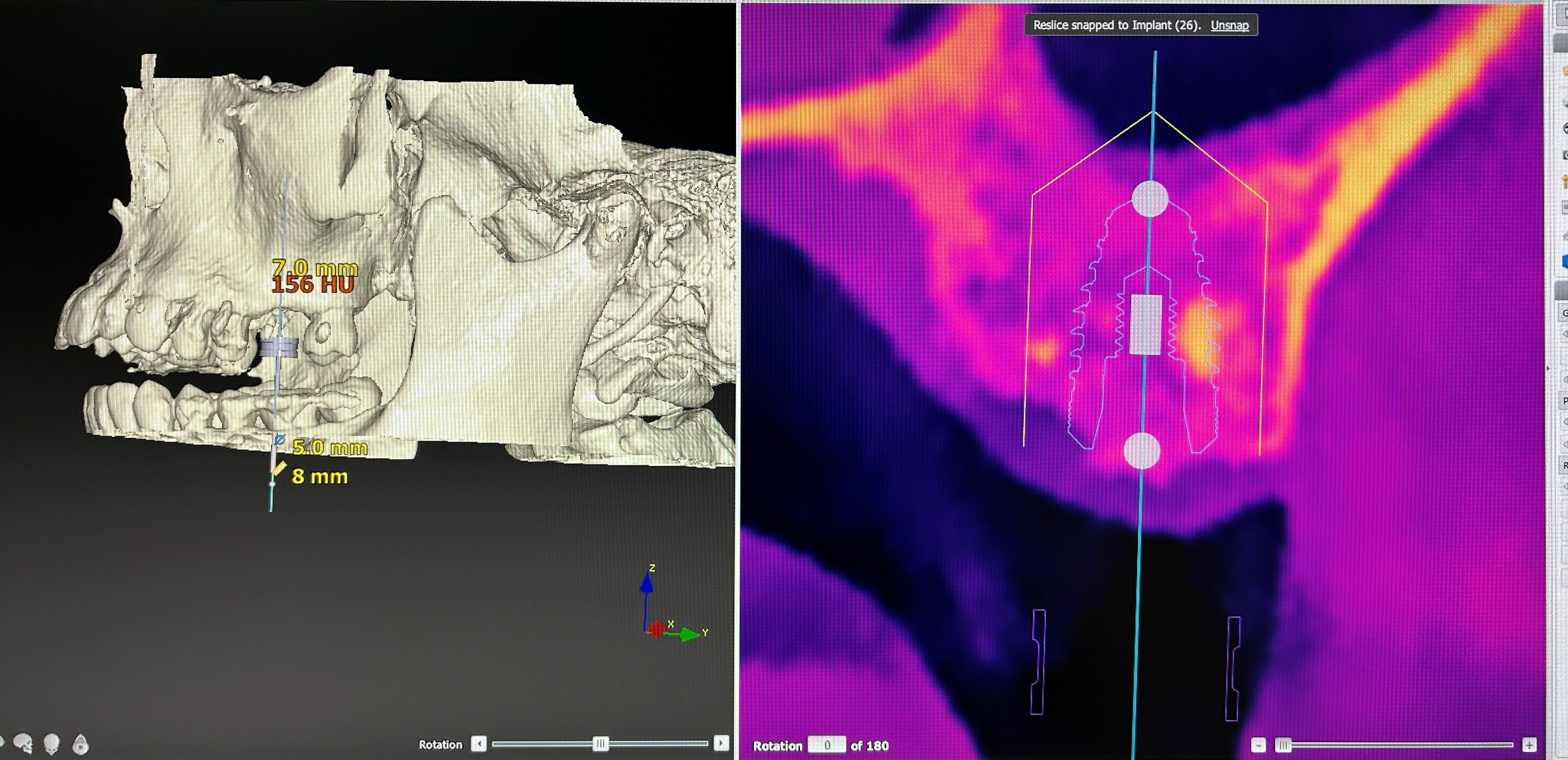Extra-short implant with transantral elevation