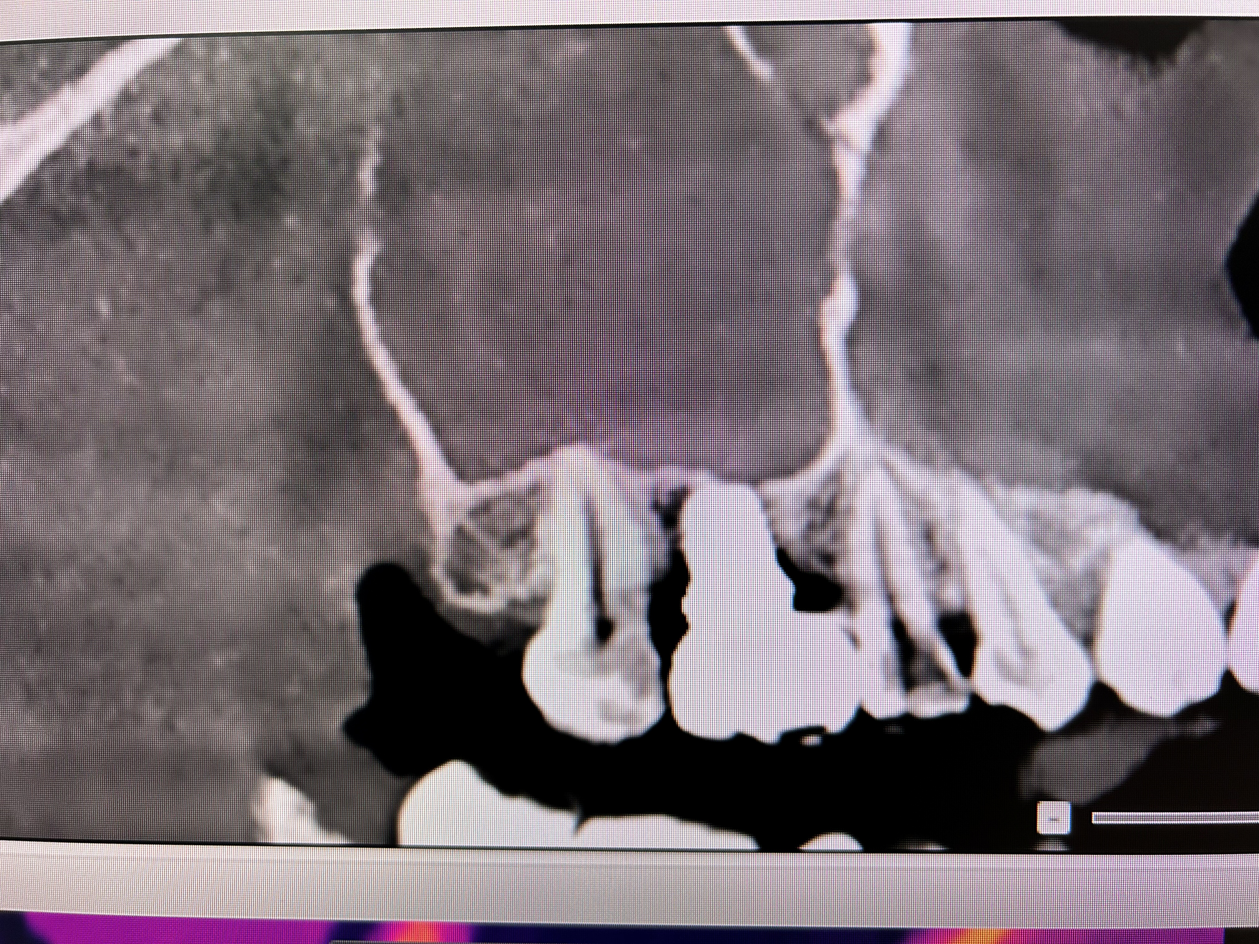 Extra-short implant with transantral elevation