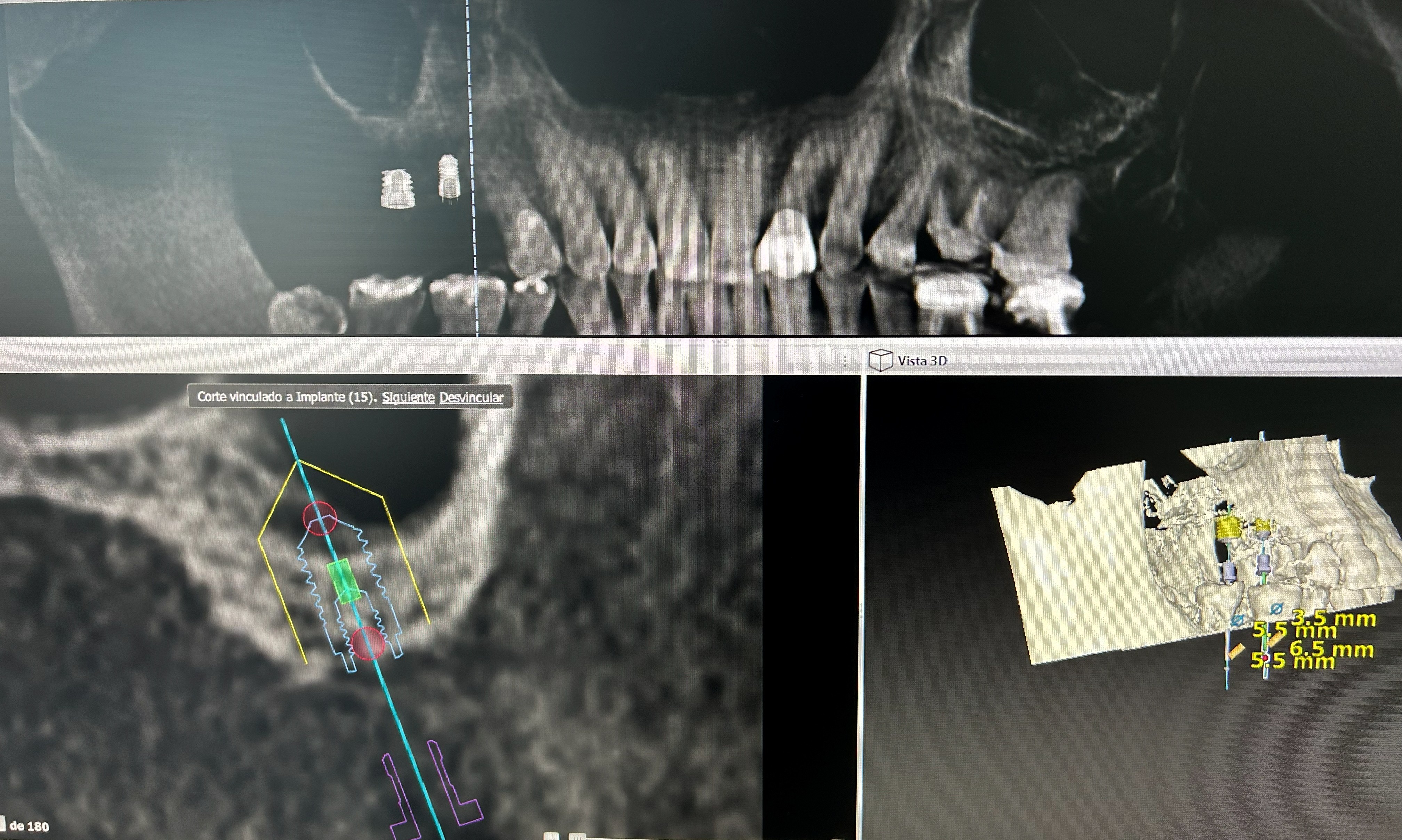 Extra-short implants