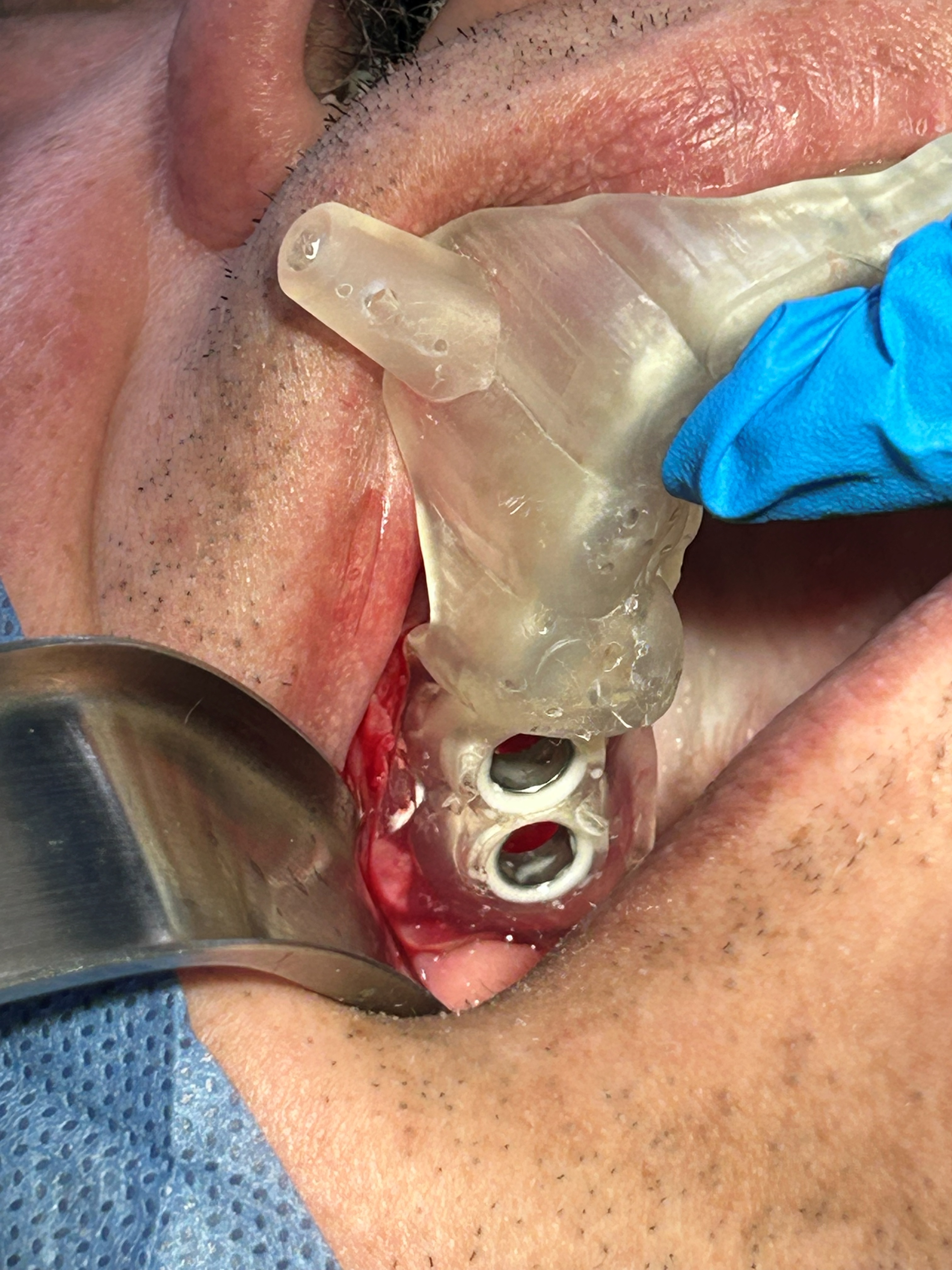 Extra-short implants