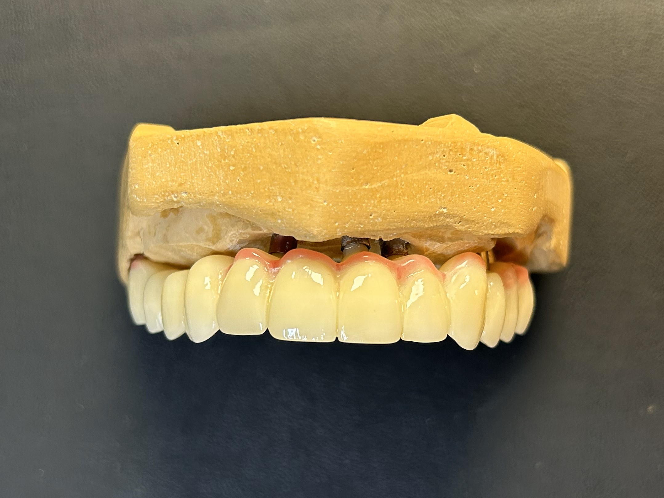 Implant-supported prosthetic rehabilitation
