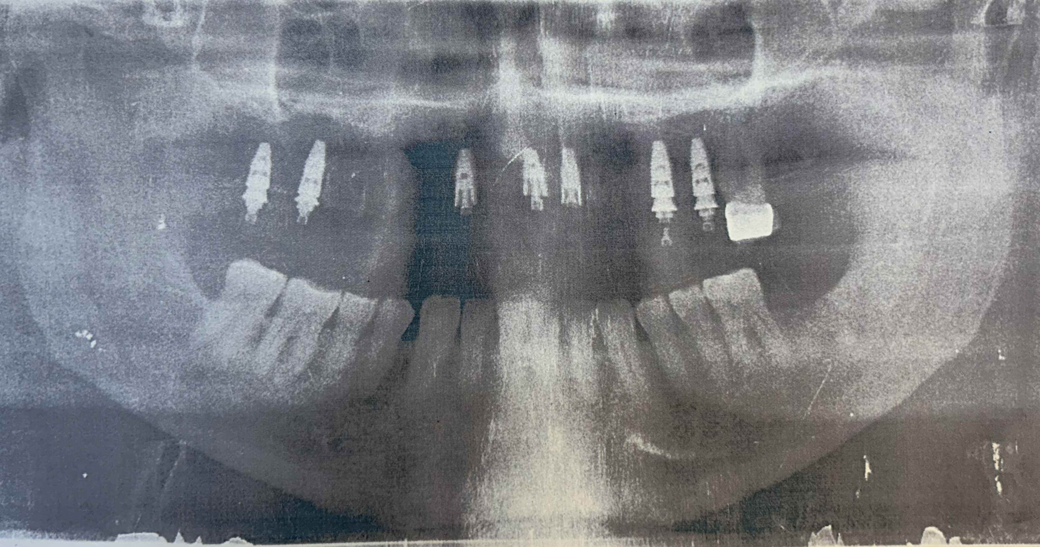 Implant-supported prosthetic rehabilitation