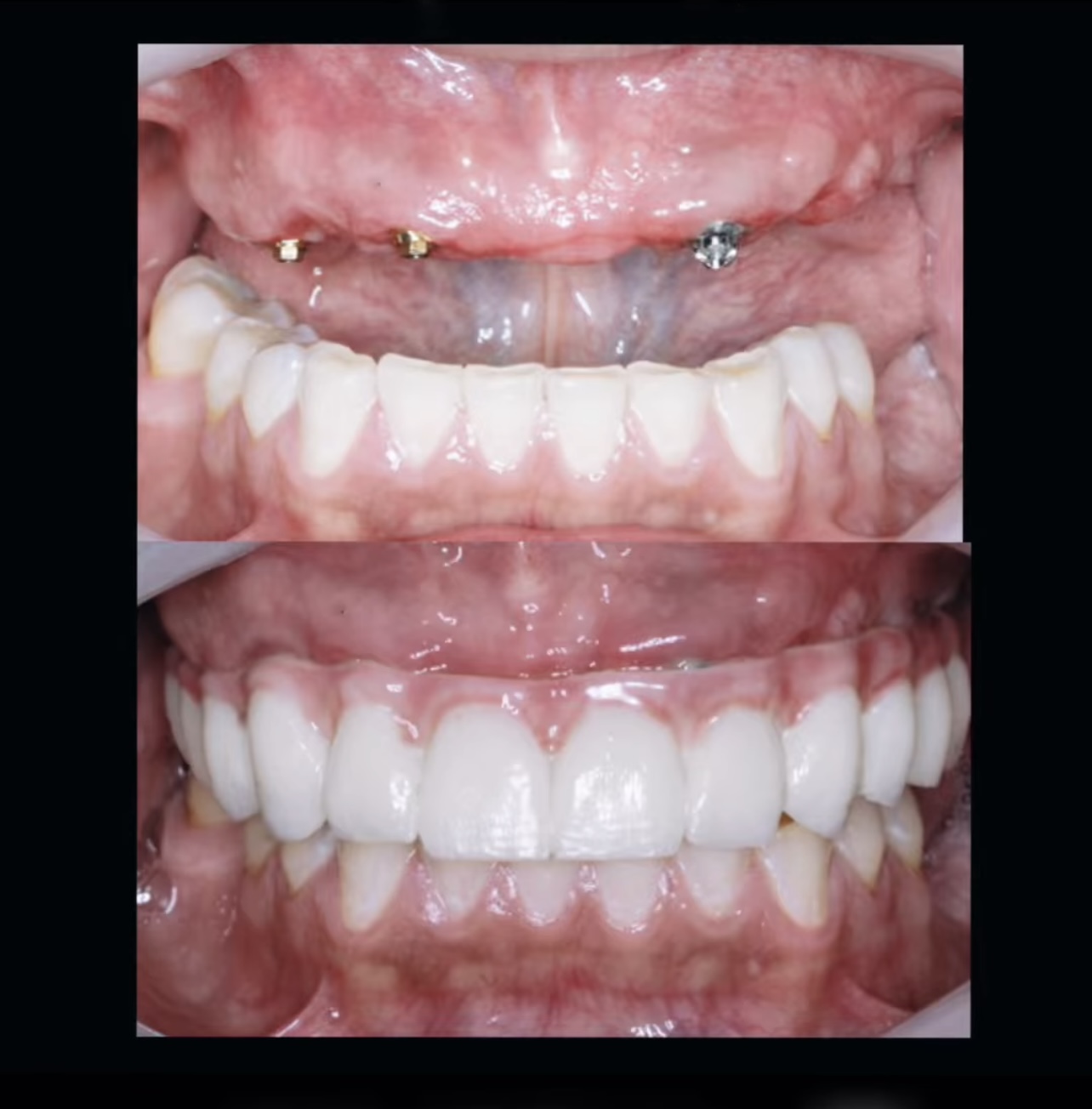 Implant-supported prosthetic rehabilitation