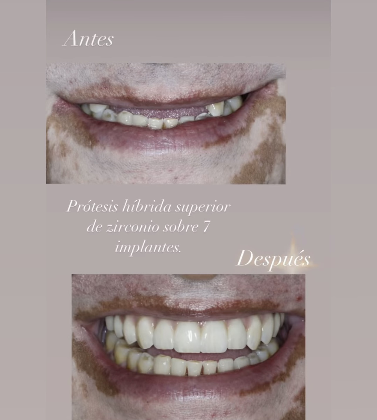 Implant-supported prosthetic rehabilitation