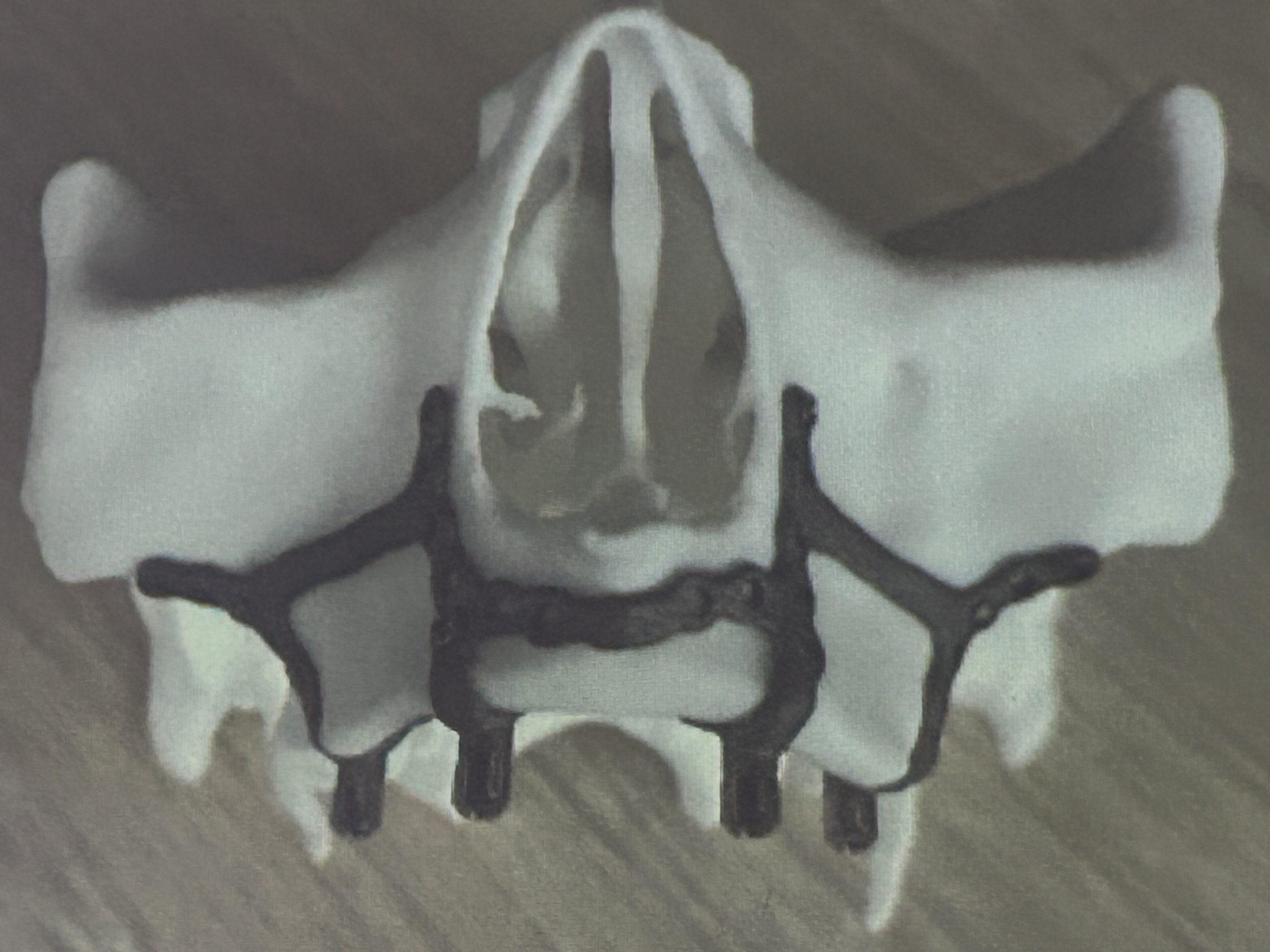 Caso clínico: implantes subperiósticos