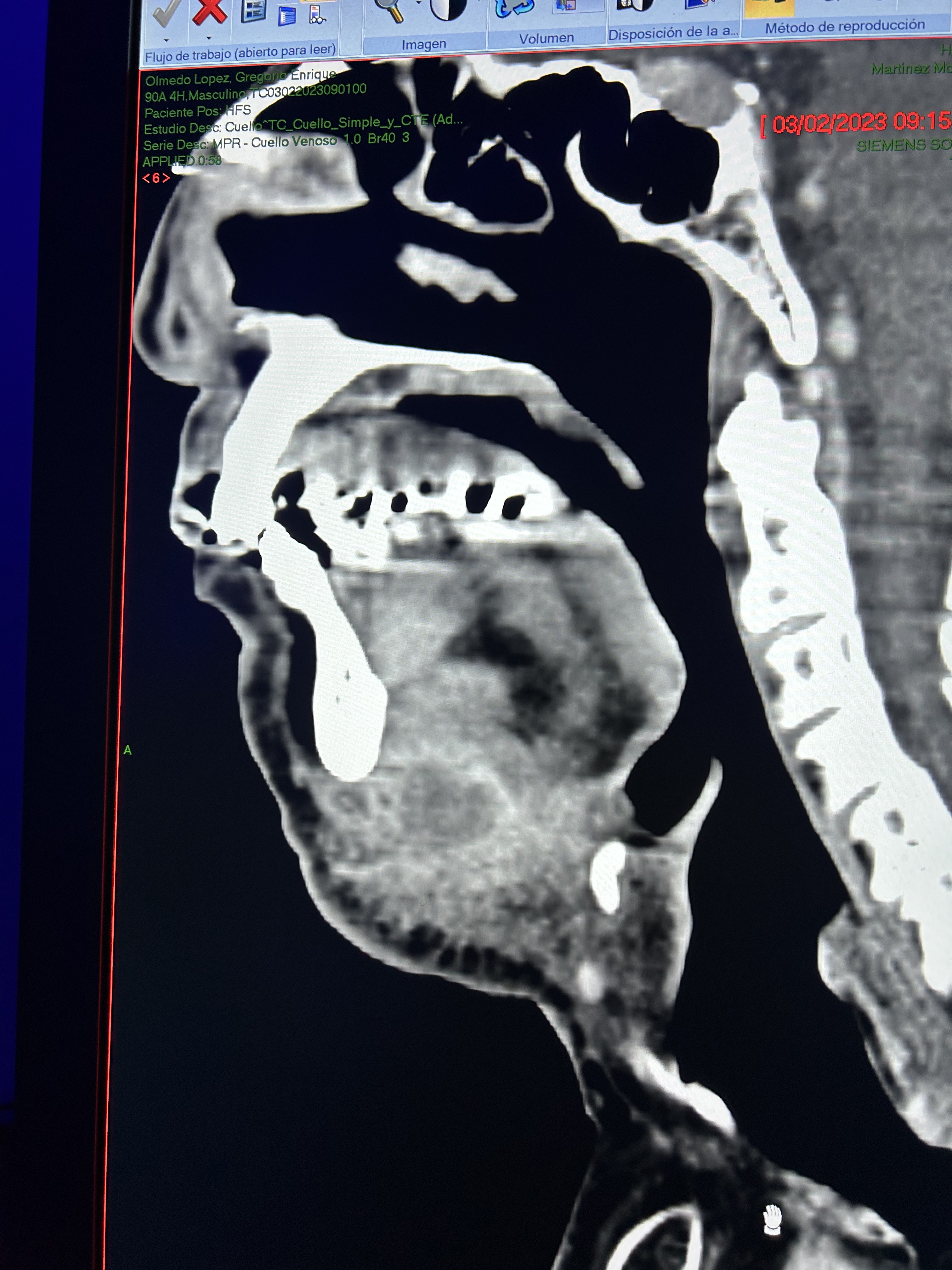 Angina de Ludwig