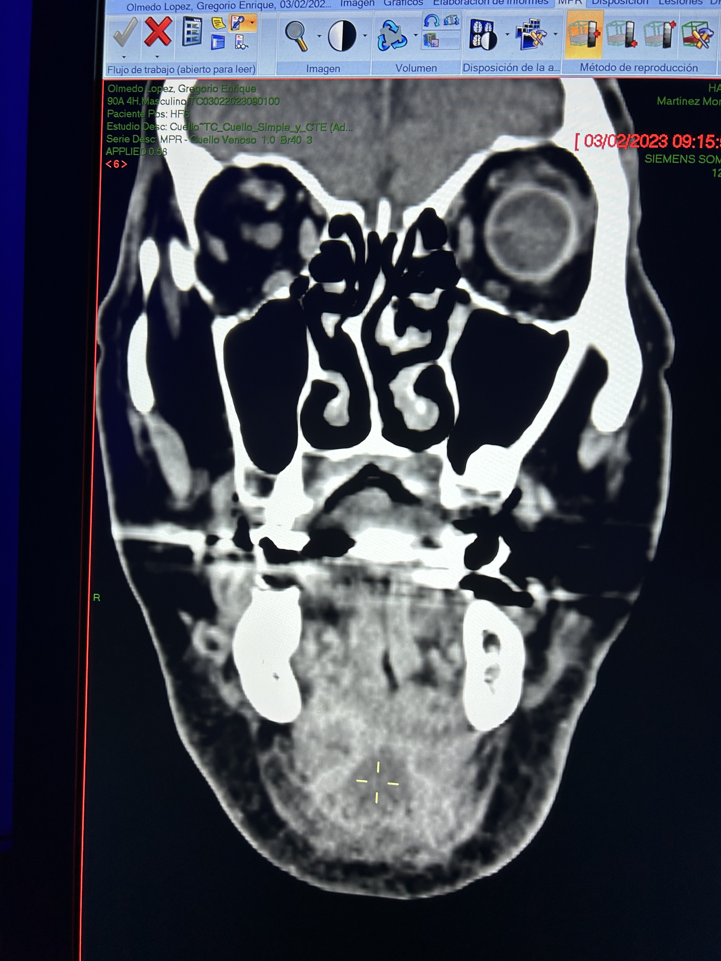 Angina de Ludwig