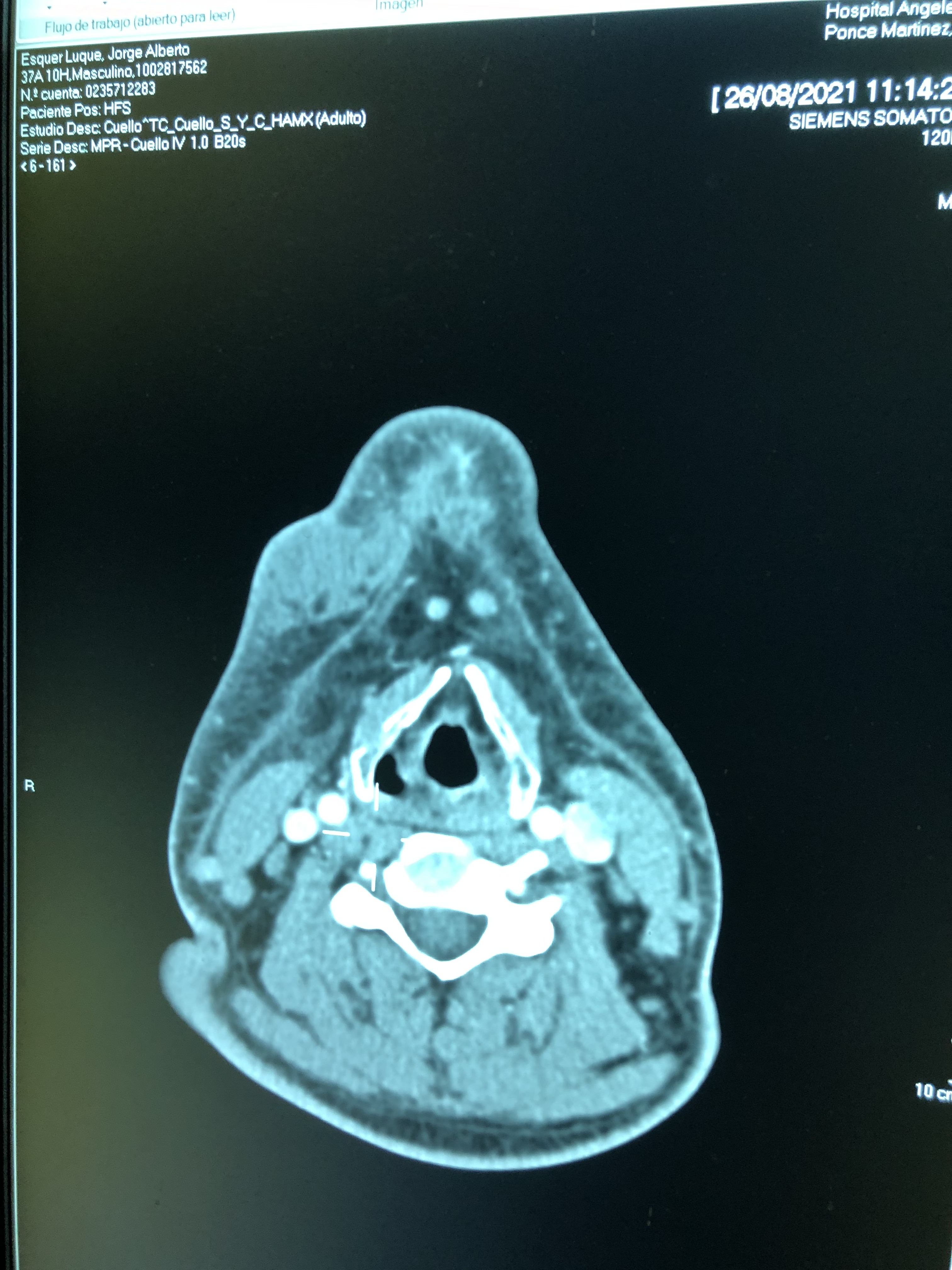Drenaje de absceso submandibular