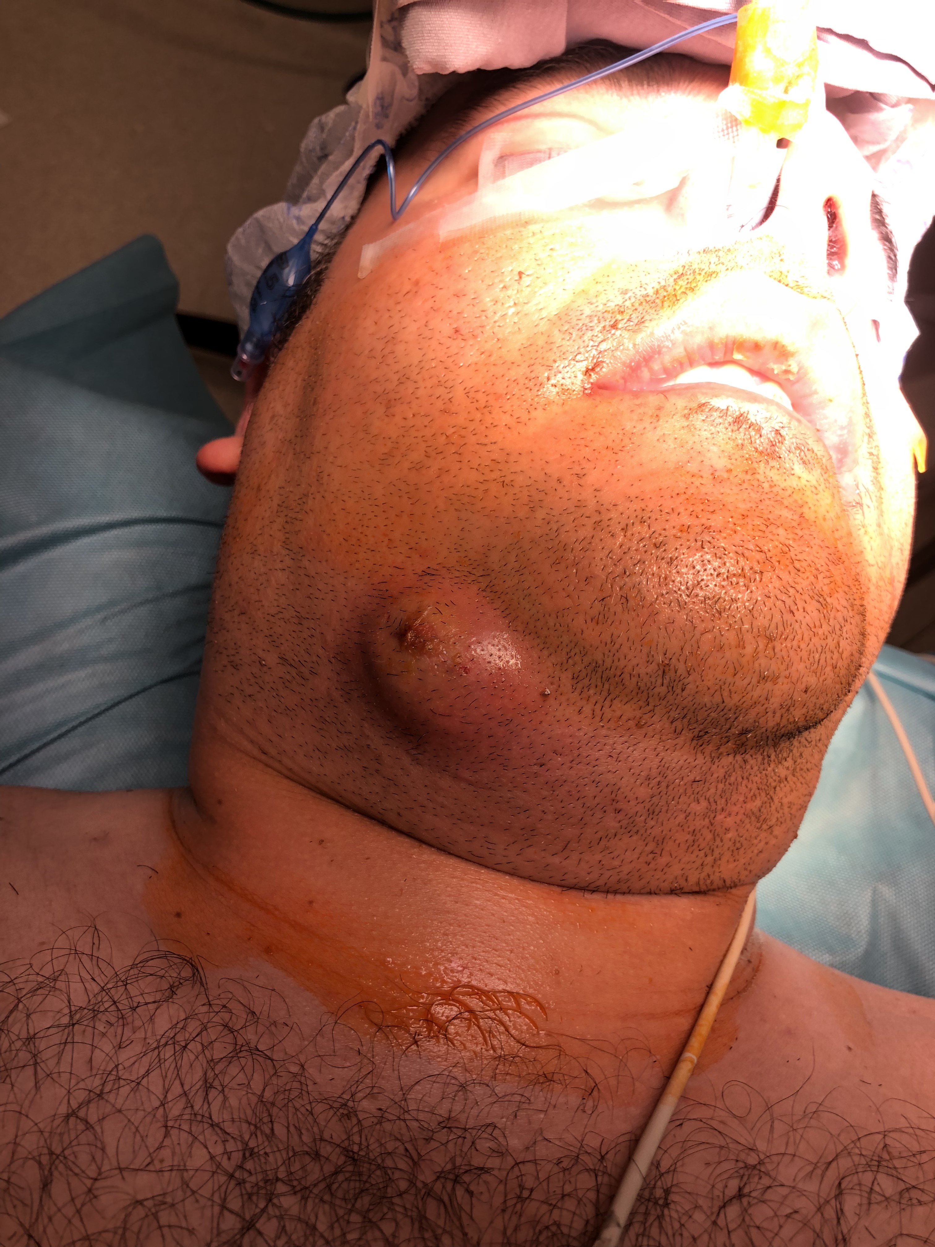 Drenaje de absceso submandibular