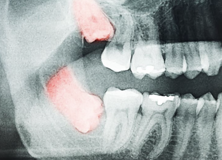 Third molar malposition