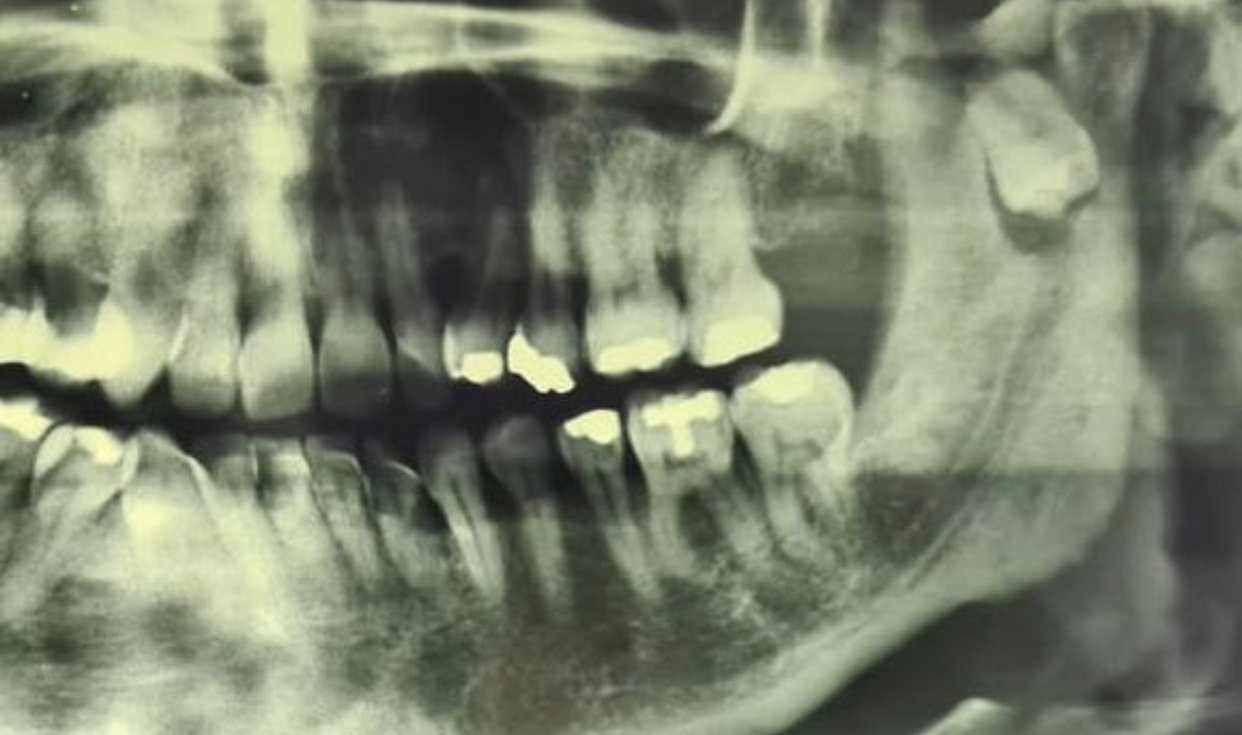 Third molar malposition