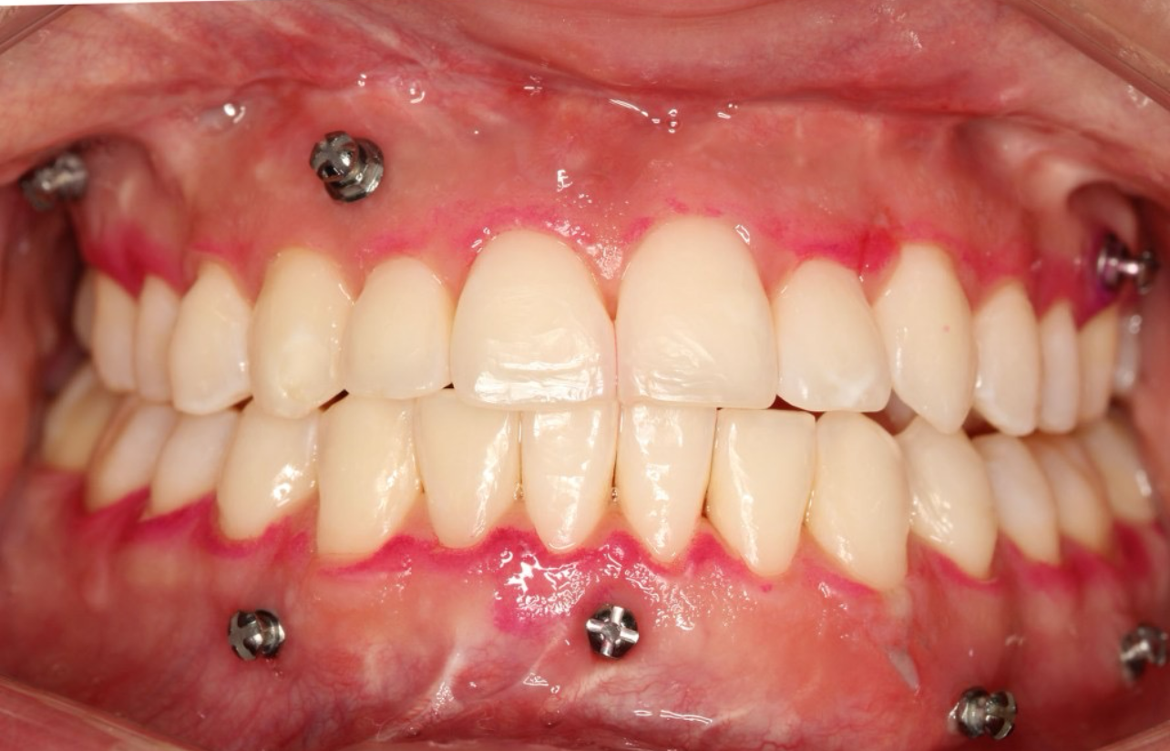 Orthodontic mini-implants