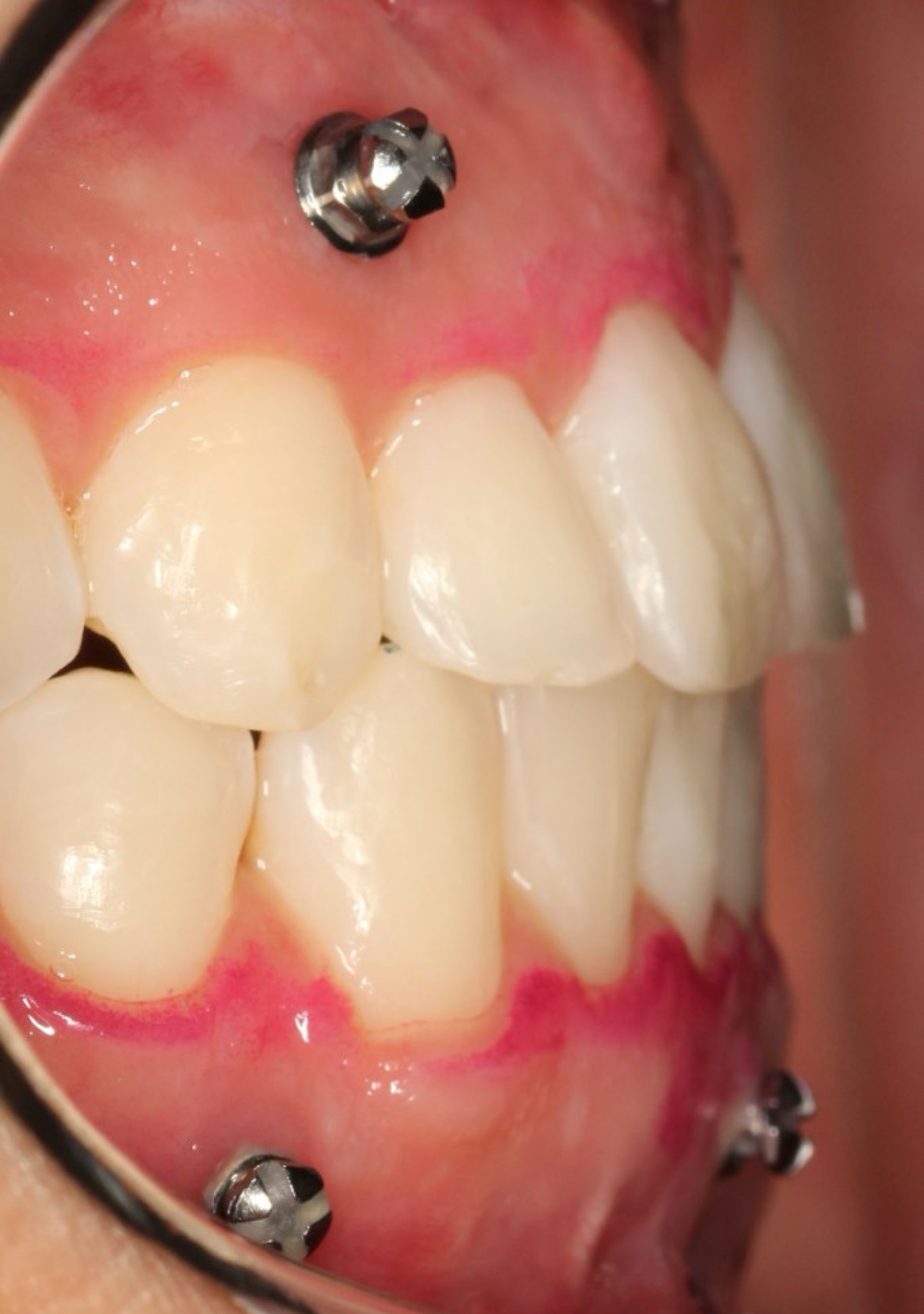 Orthodontic mini-implants