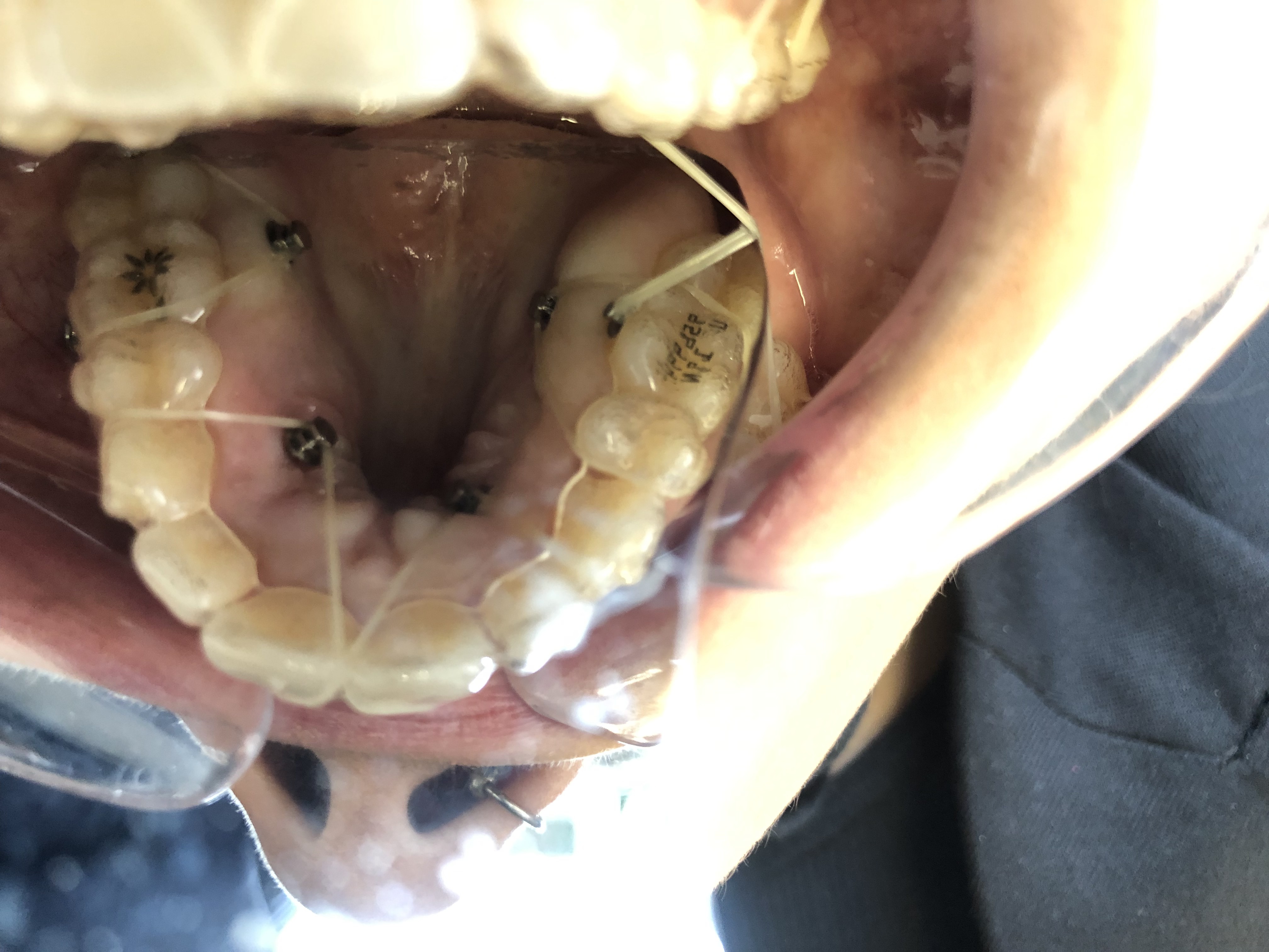 Orthodontic mini-implants (clinical case)