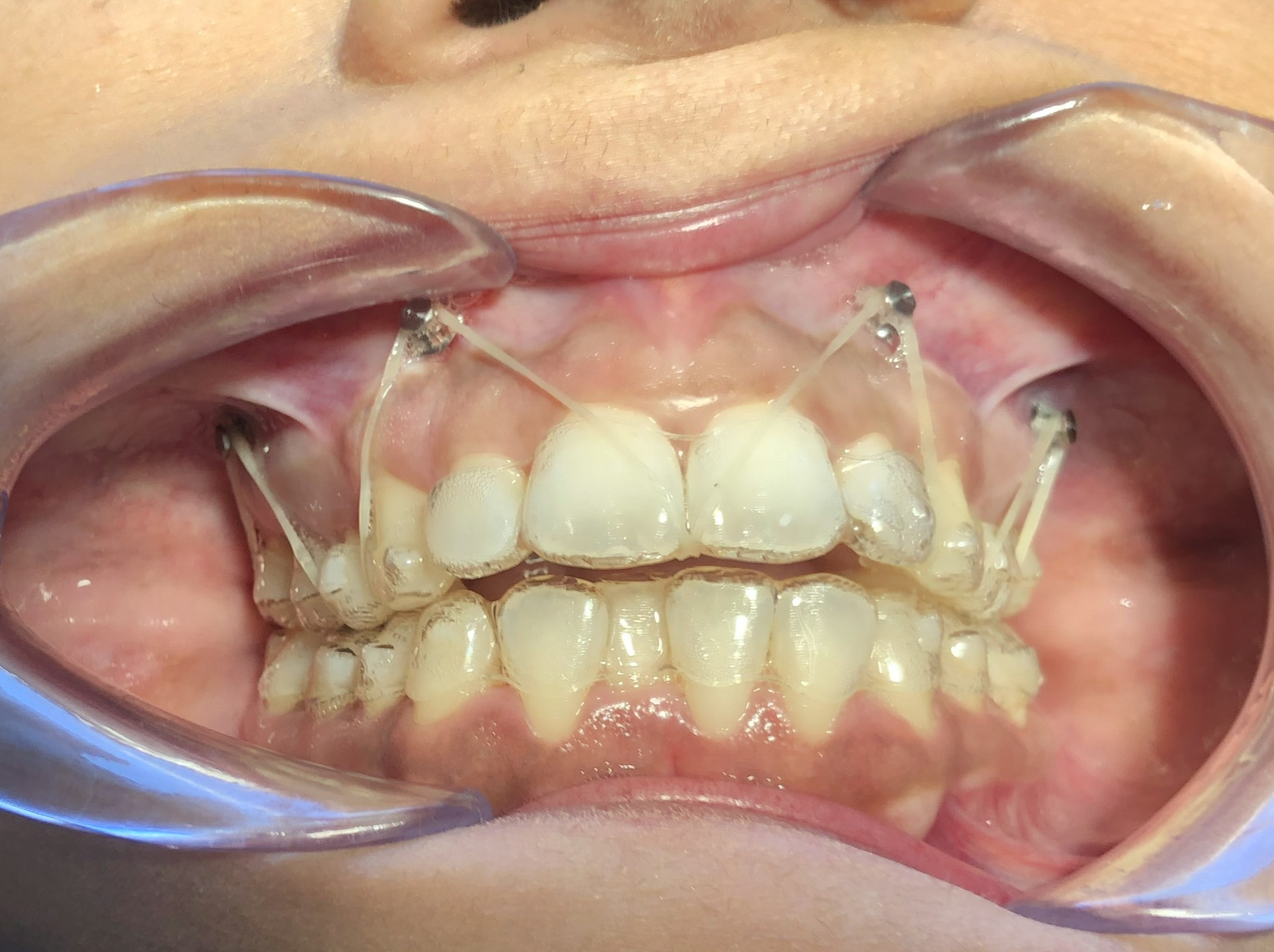 Orthodontic mini-implants