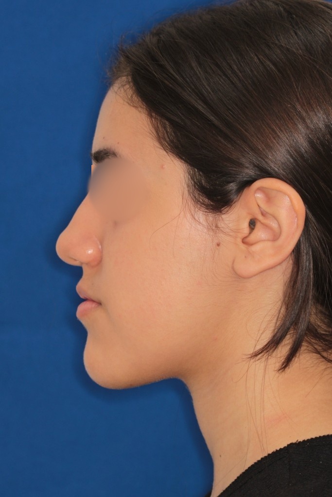 Mandibular laterognathia